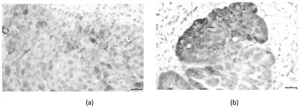 A prognostic diagnostic marker claudin22 for ovarian cancer and its application