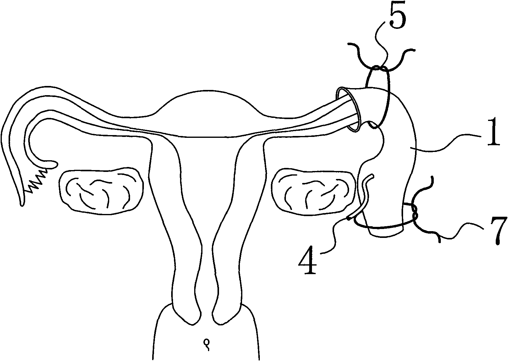 Reducible uterine tube birth control sleeve