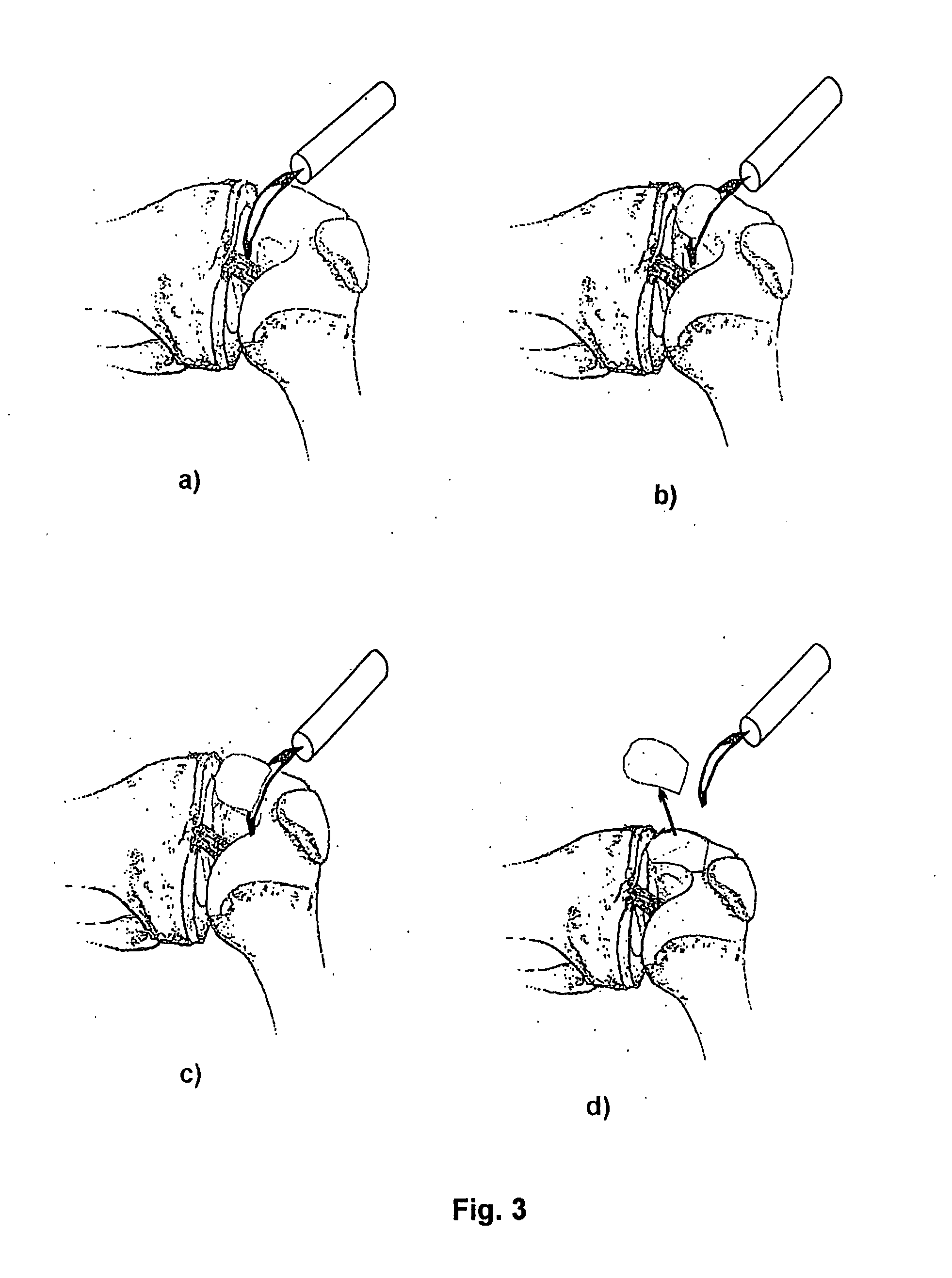 Articular cartilage, device and method for repairing cartilage defects