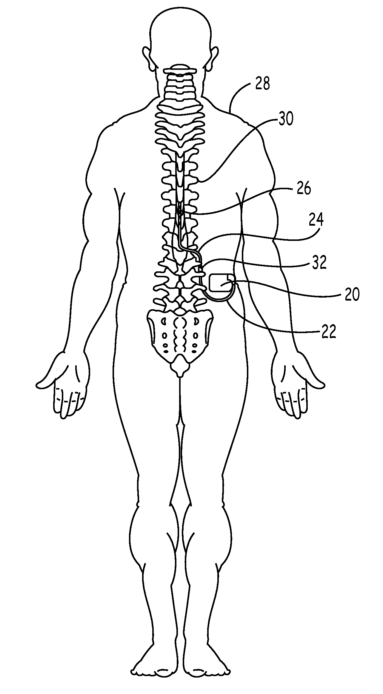 Implantable device with shield integrated lead connector