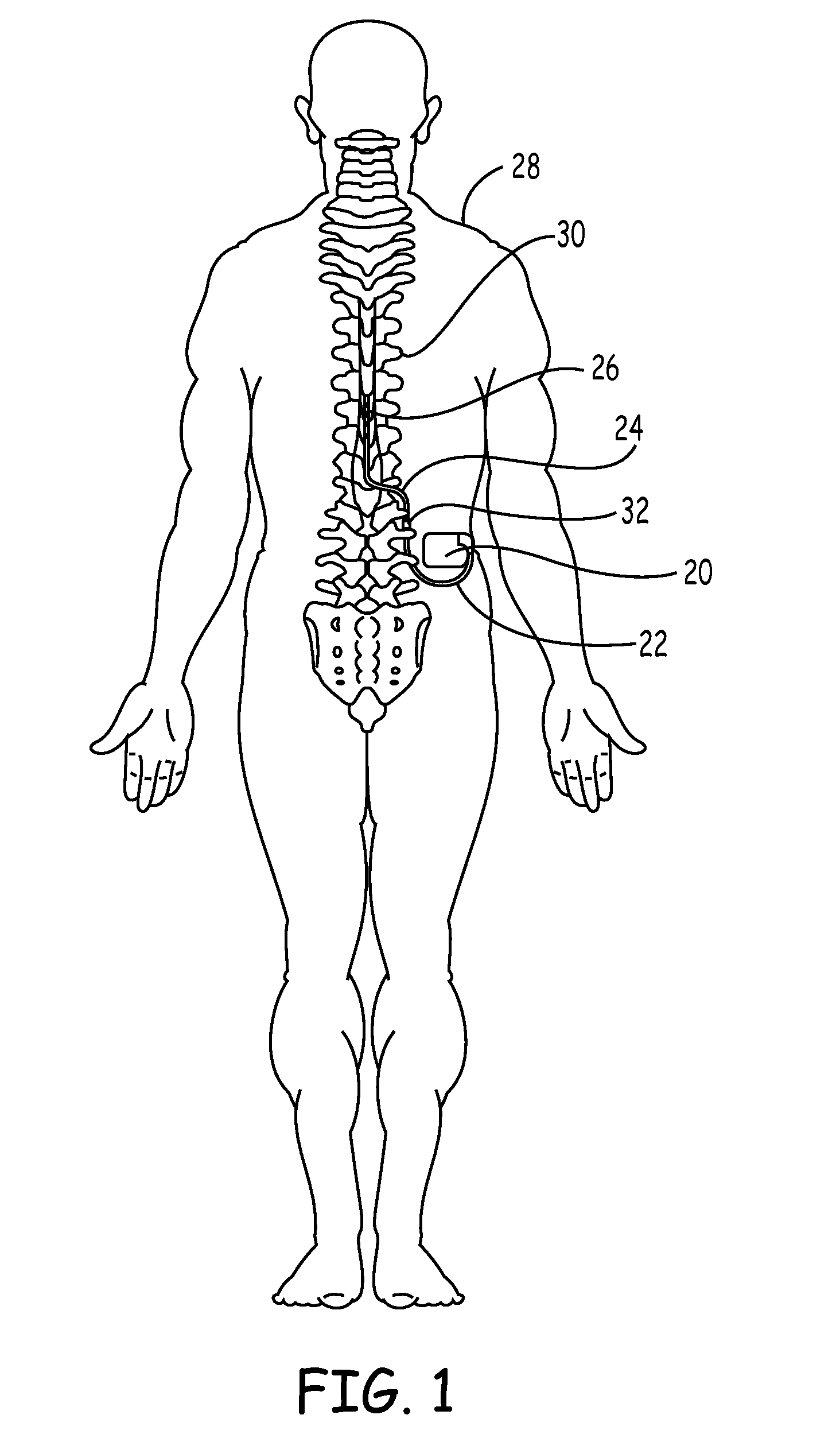 Implantable device with shield integrated lead connector