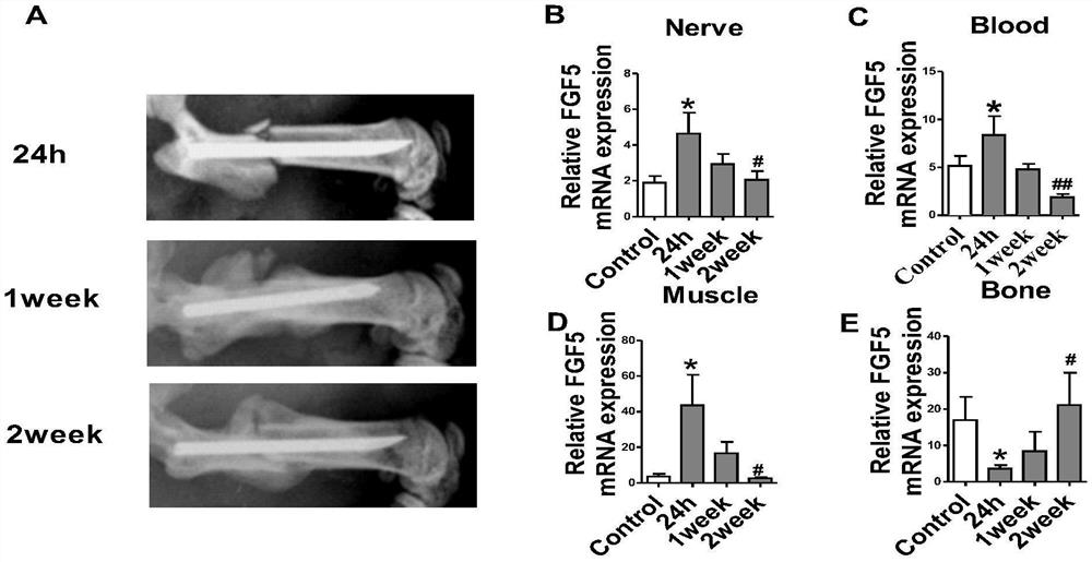 Application of Recombinant Human Fibroblast Growth Factor-5 in Promoting Fracture Healing