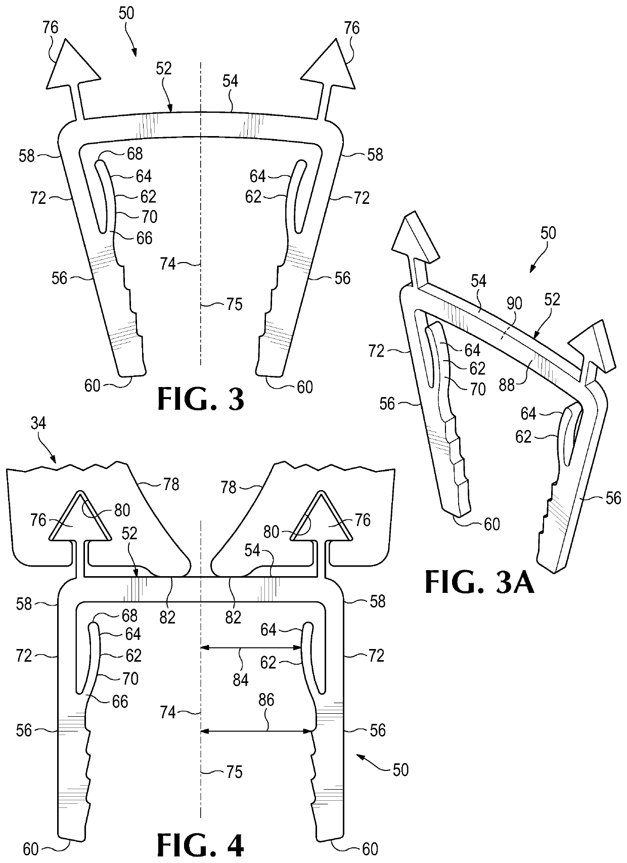 Bone clip with resilient arm for proximal compression