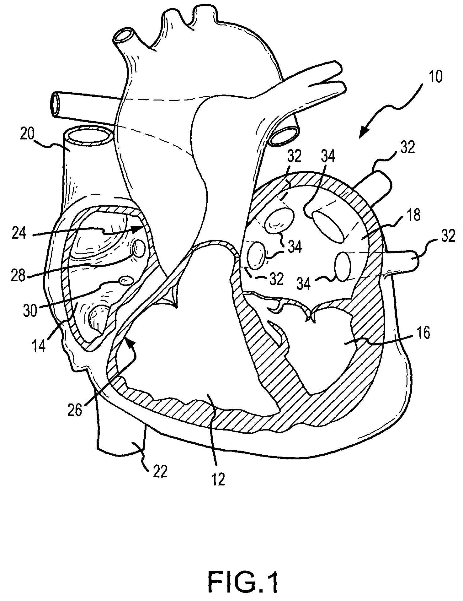 Ablation catheter and electrode