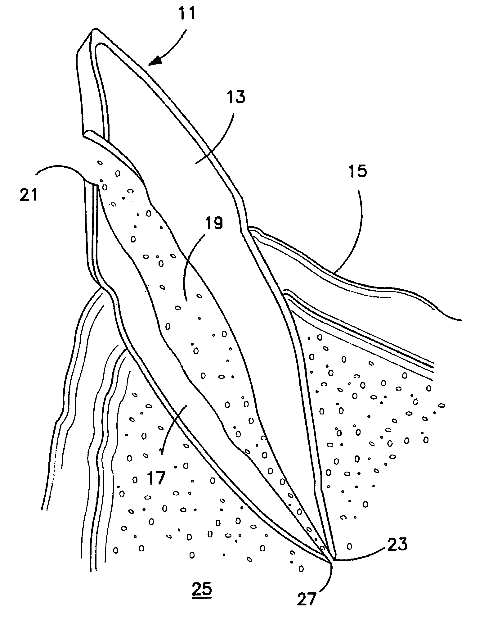 Method and apparatus for evacuation of root canal