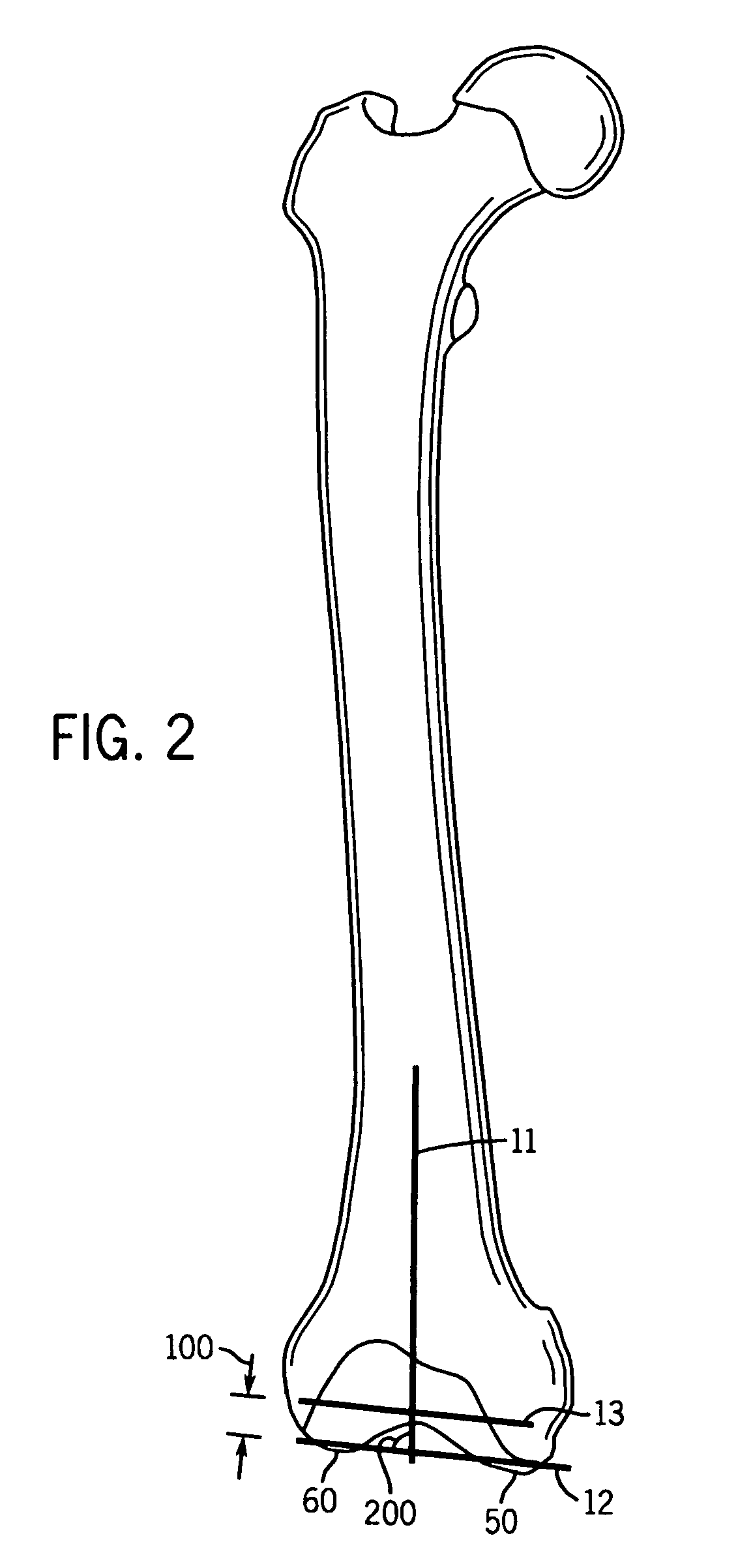 Method and system for determining resection guidelines for joint replacement surgical procedures