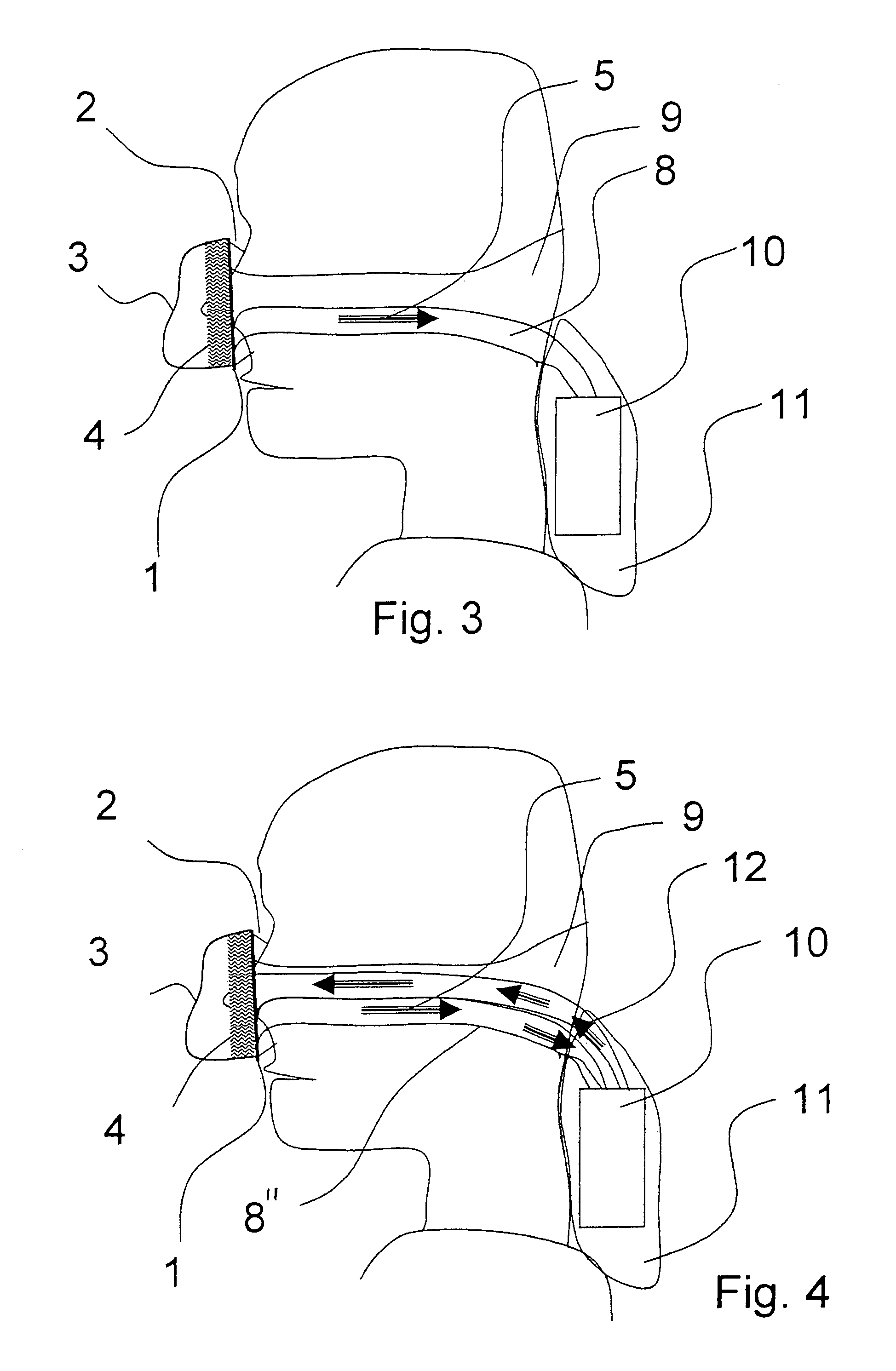 Breathing mask with integrated suction area