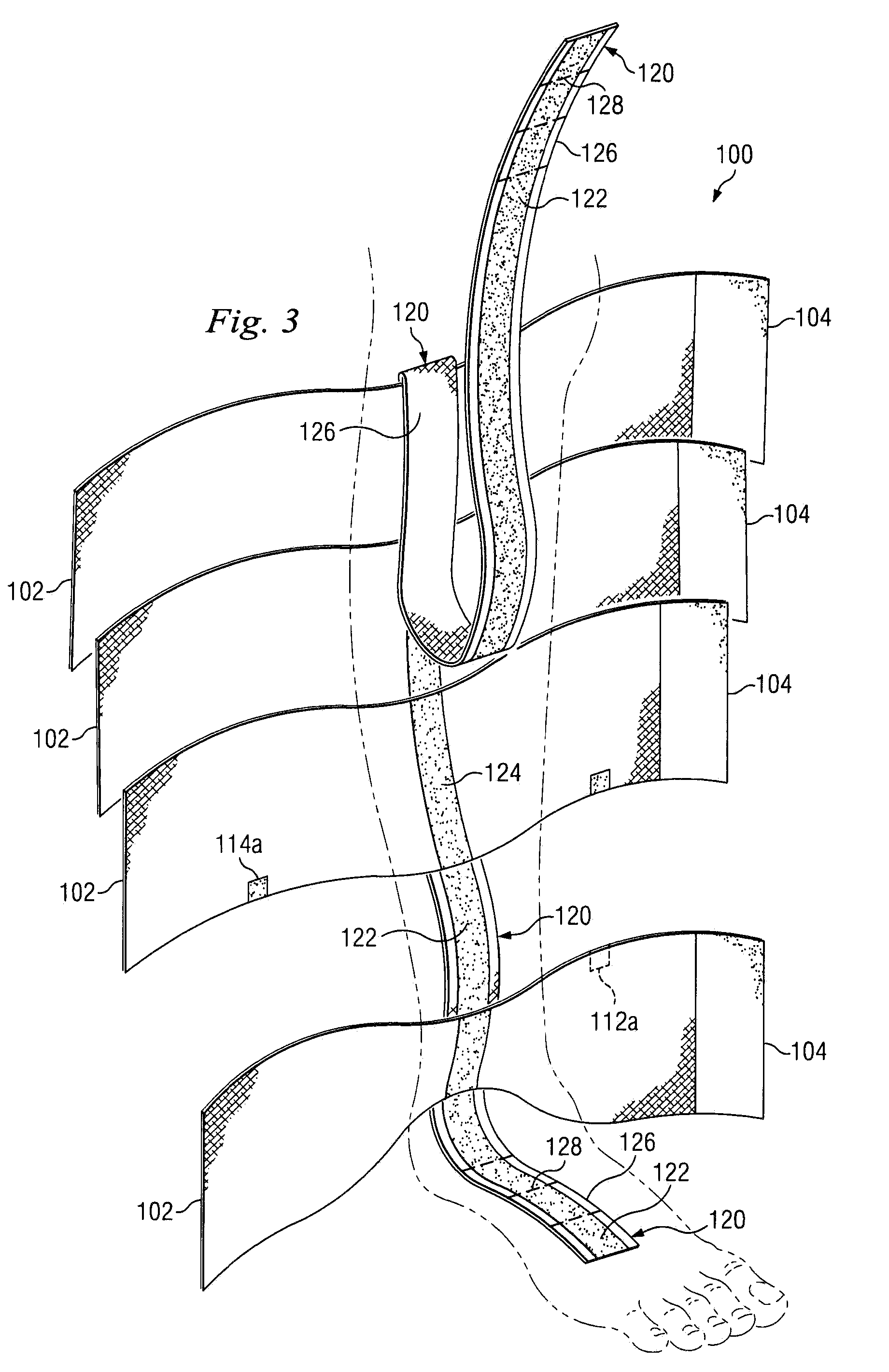 Compression-garment band method