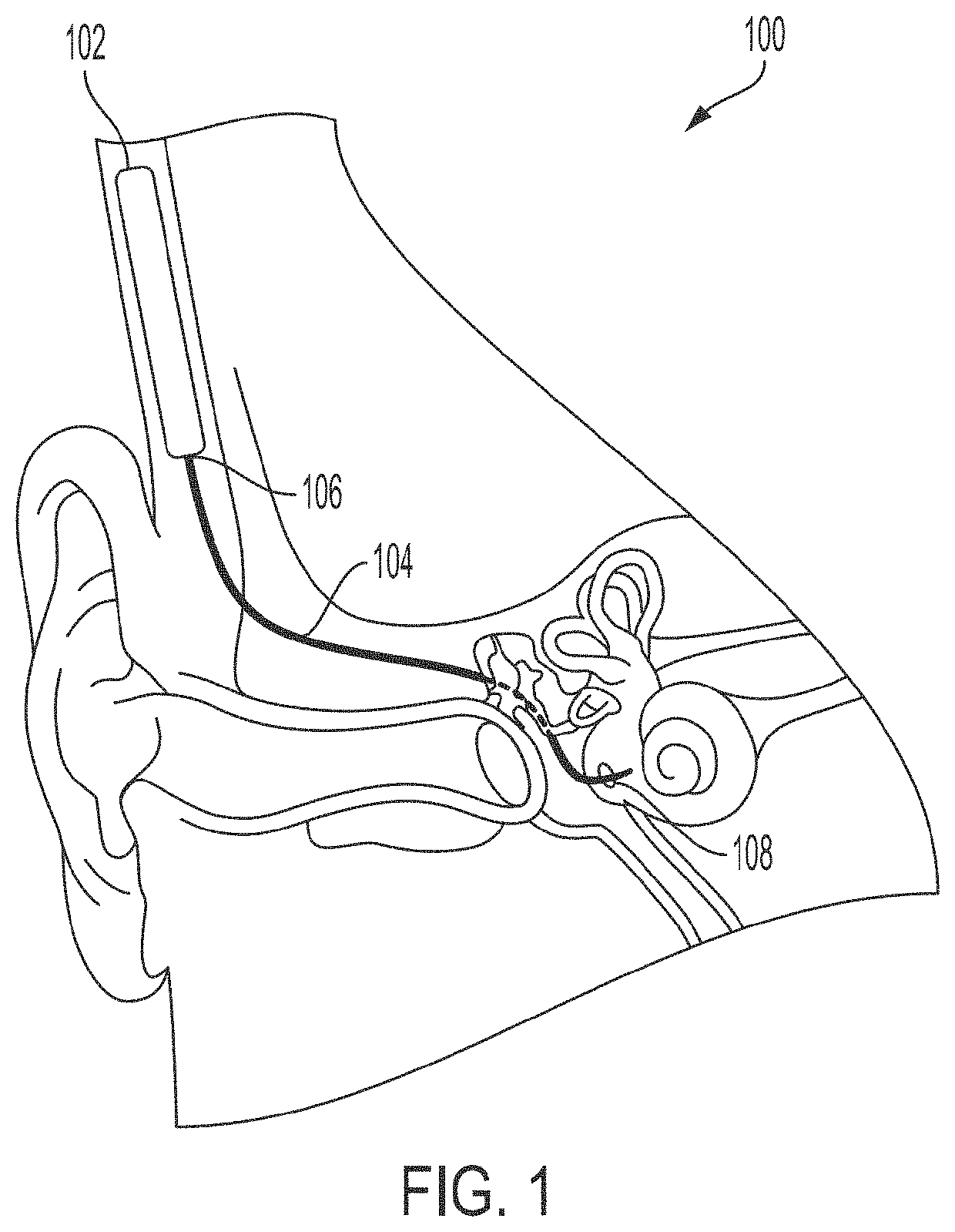 Apparatus and method for trans-round window membrane drug delivery