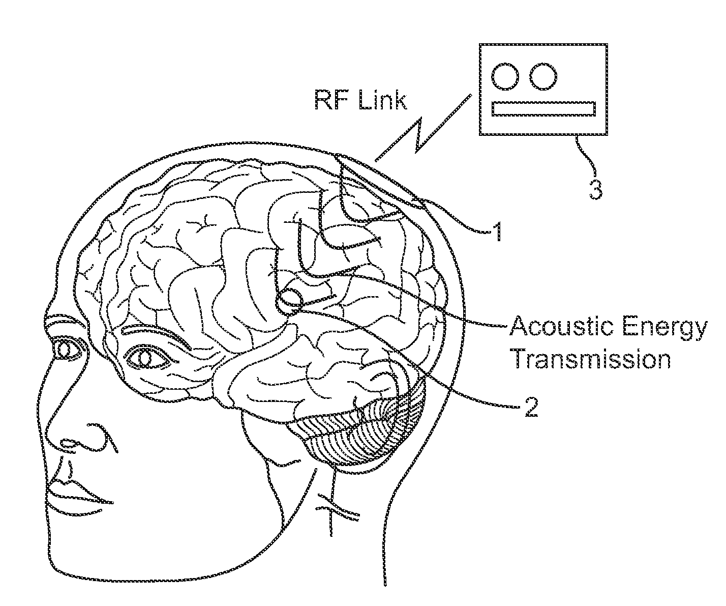 Systems and methods for implantable leadless brain stimulation