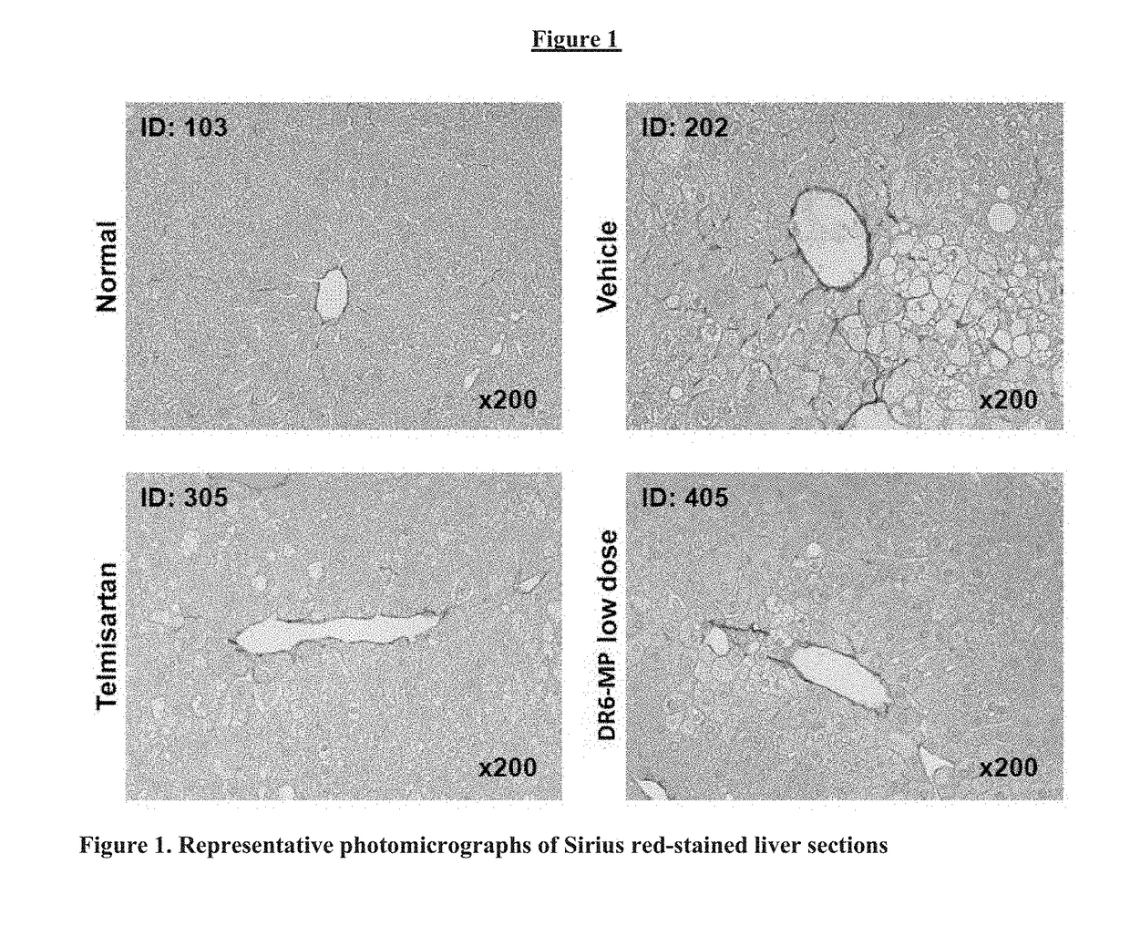 Treatment of non-alcoholic fatty liver disease or non-alcoholic steatohepatitis with delayed-release 6-mercaptopurine