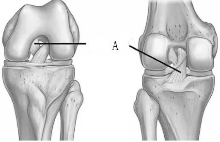 Medical internal fixator for posterior cruciate ligament lower dead center avulsion fracture