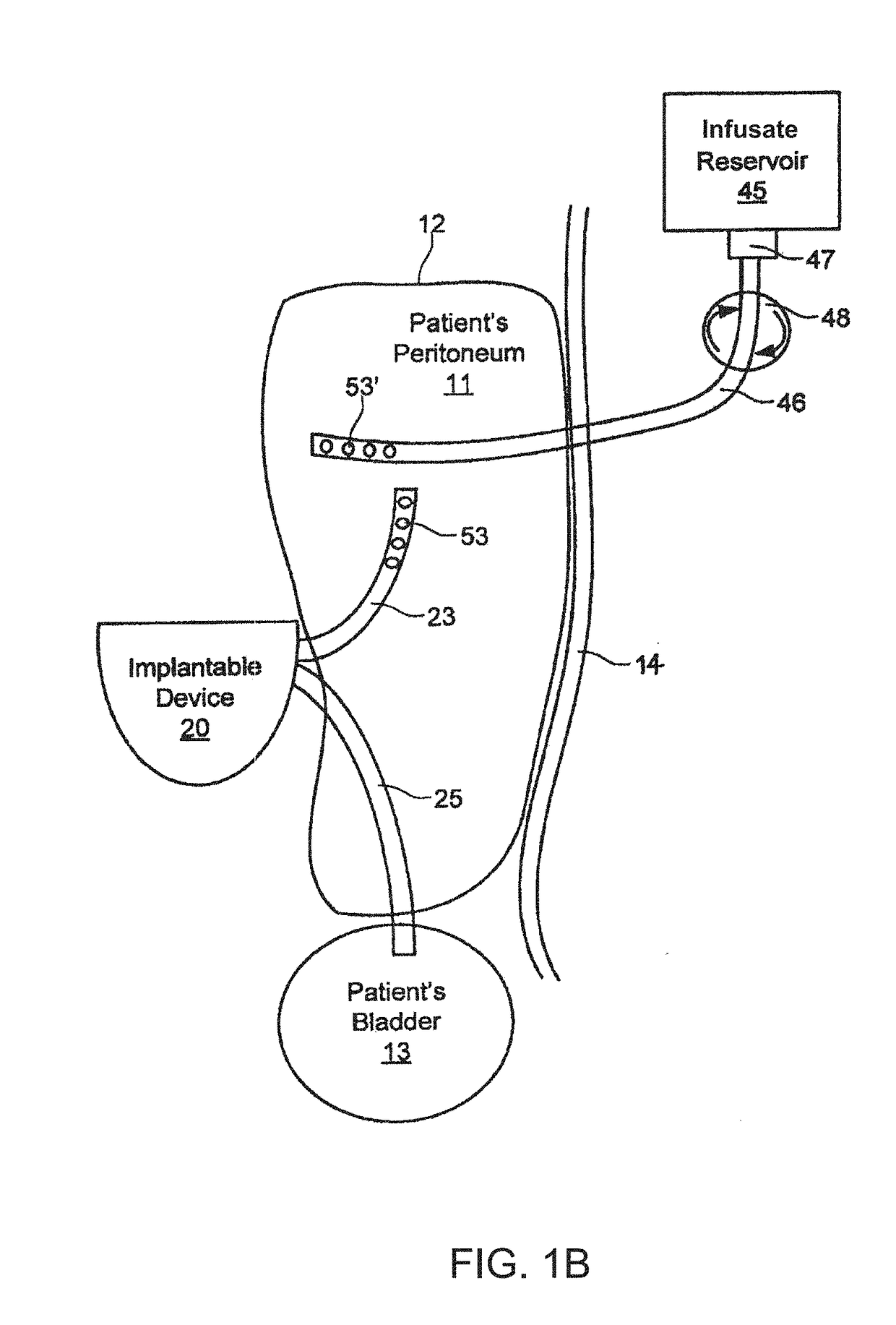 Direct sodium removal method, solution and apparatus to reduce fluid overload in heart failure patients