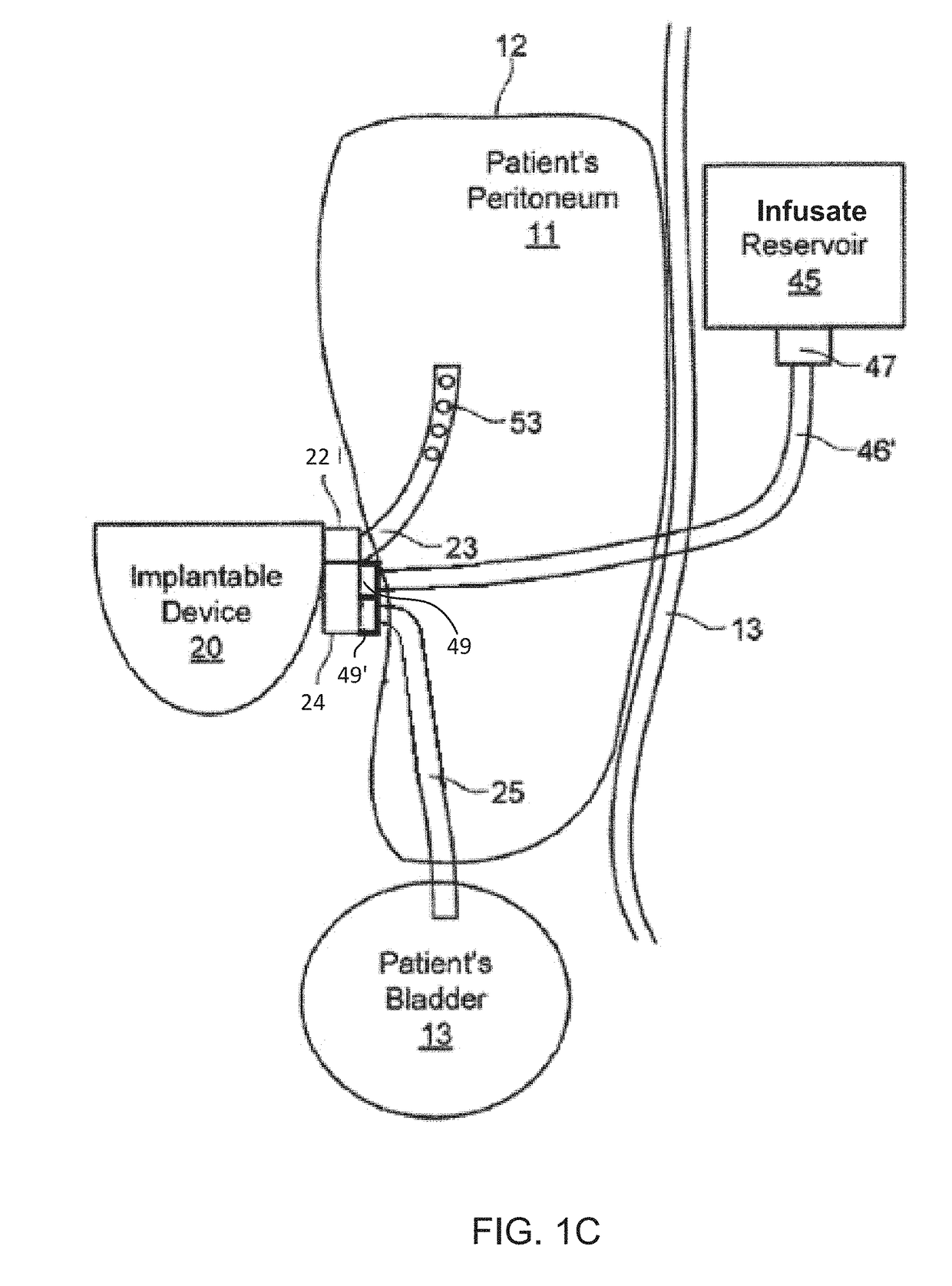 Direct sodium removal method, solution and apparatus to reduce fluid overload in heart failure patients
