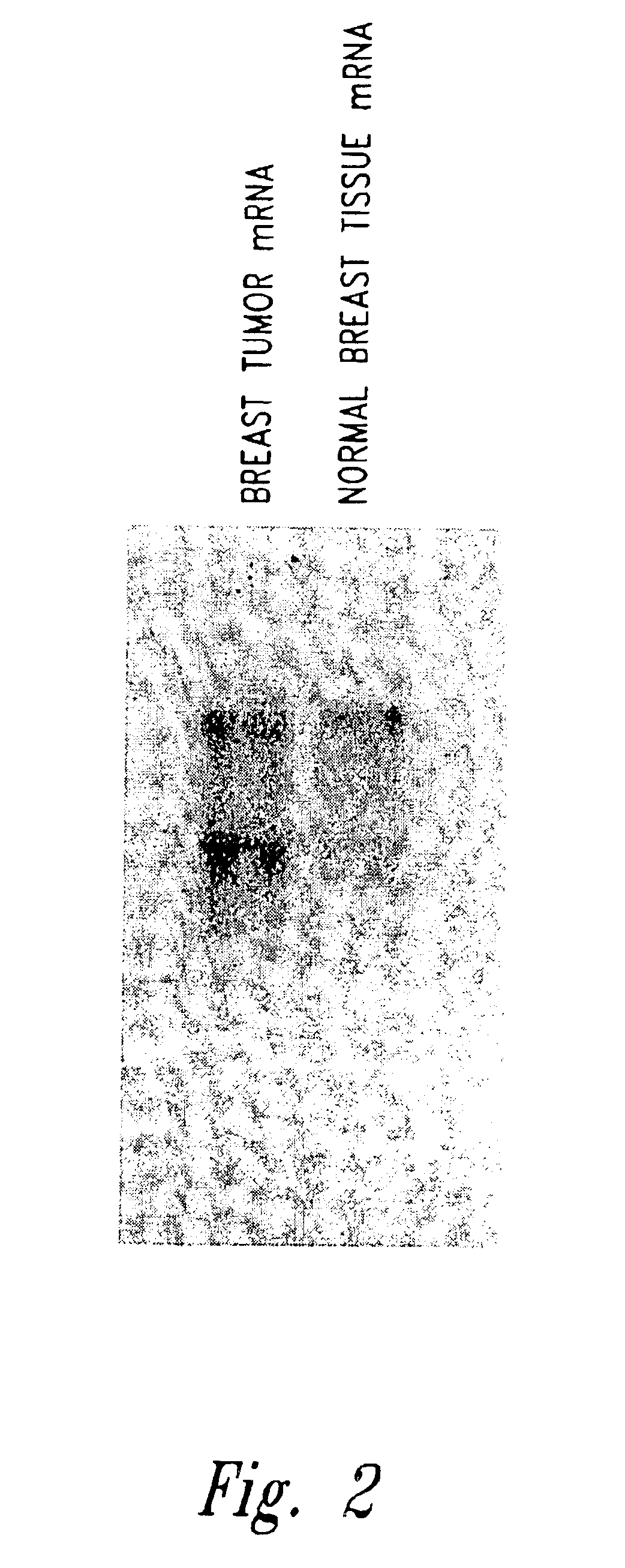Compositions and methods for the treatment and diagnosis of breast cancer