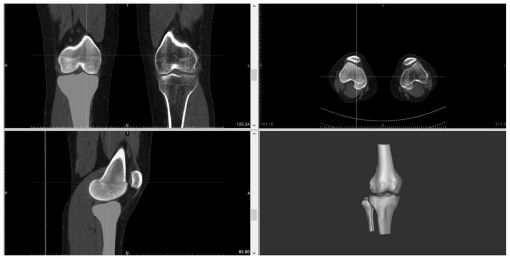 A method for simulating surgery of the discoid meniscus of the knee joint