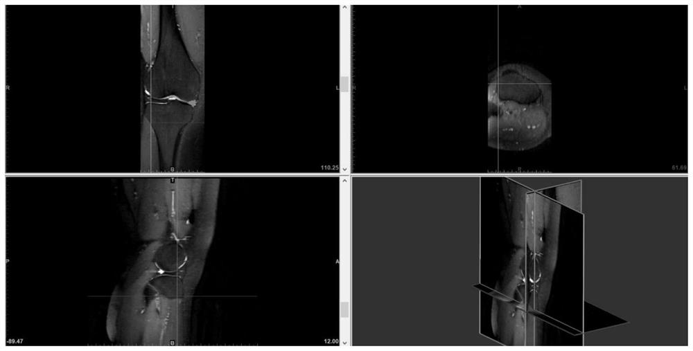 A method for simulating surgery of the discoid meniscus of the knee joint