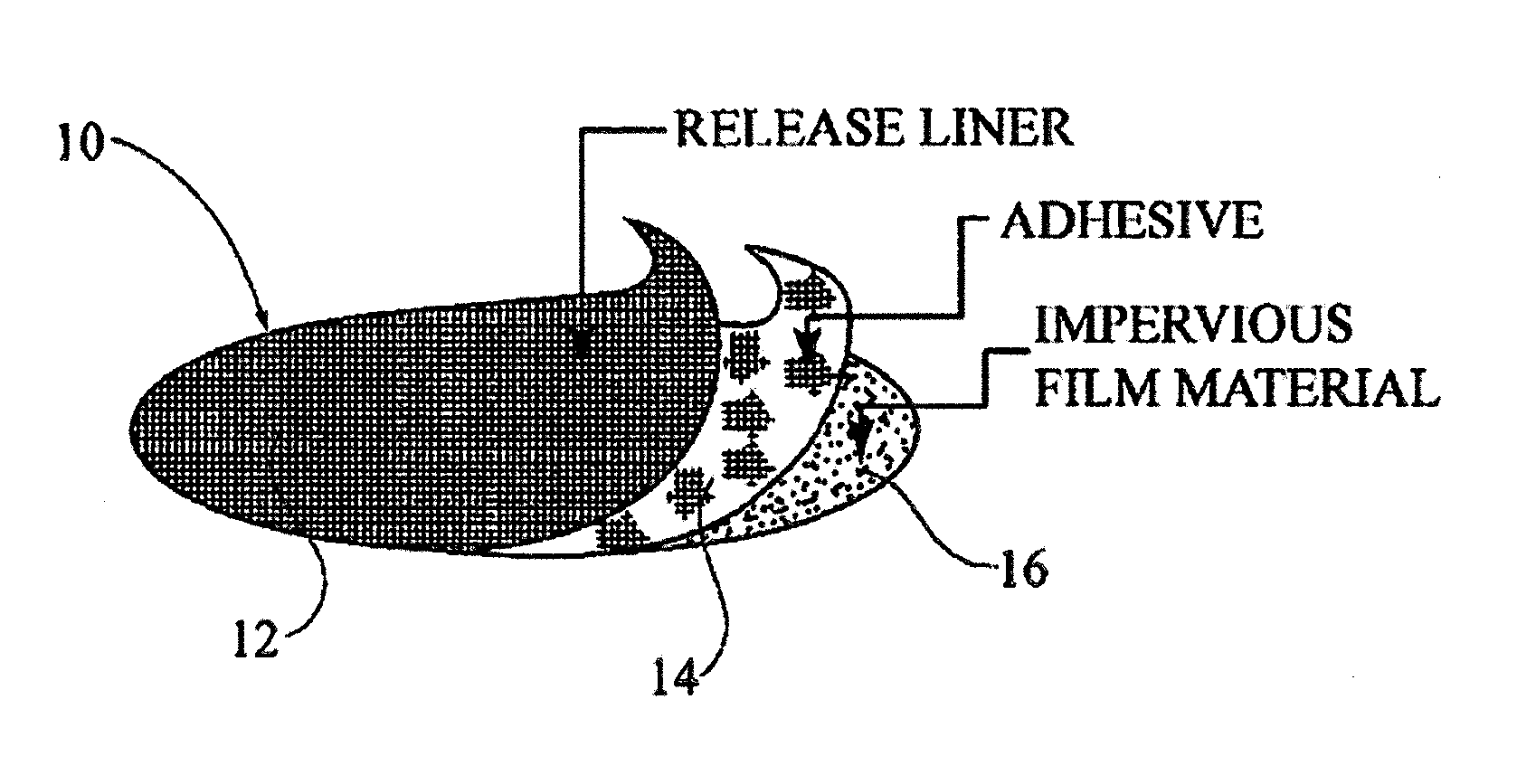 Method and device for female urinary incontinence