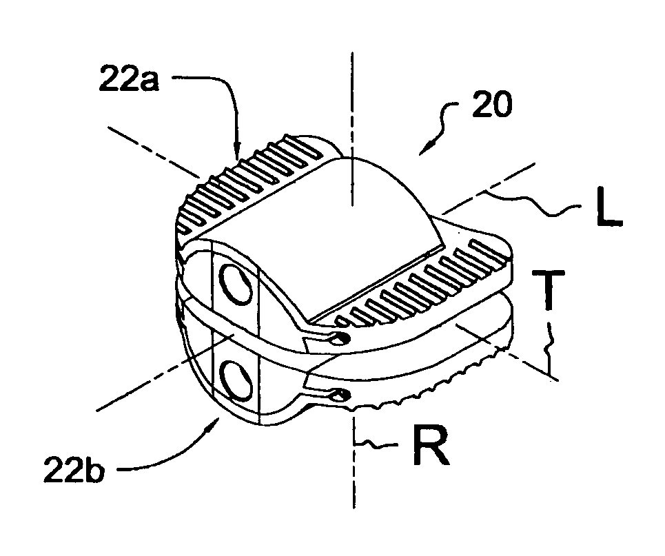 Articular disc prosthesis and method for implanting the same
