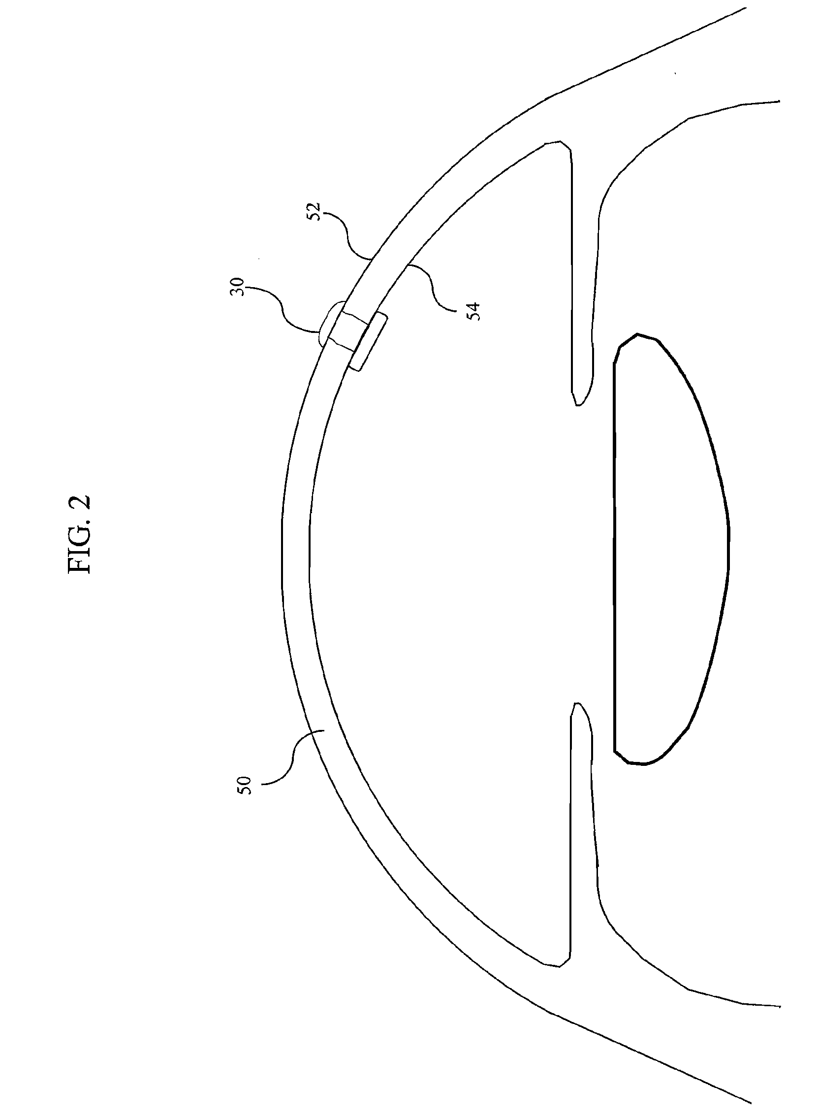 Instruments and methods for implanting corneal implant via extra-and intra-cameral routes