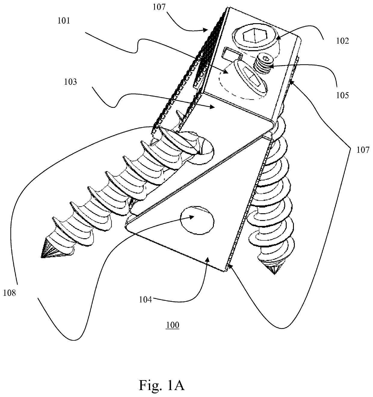 Bi-directional fixating transvertebral body screws and posterior cervical and lumbar interarticulating joint calibrated stapling devices for spinal fusion