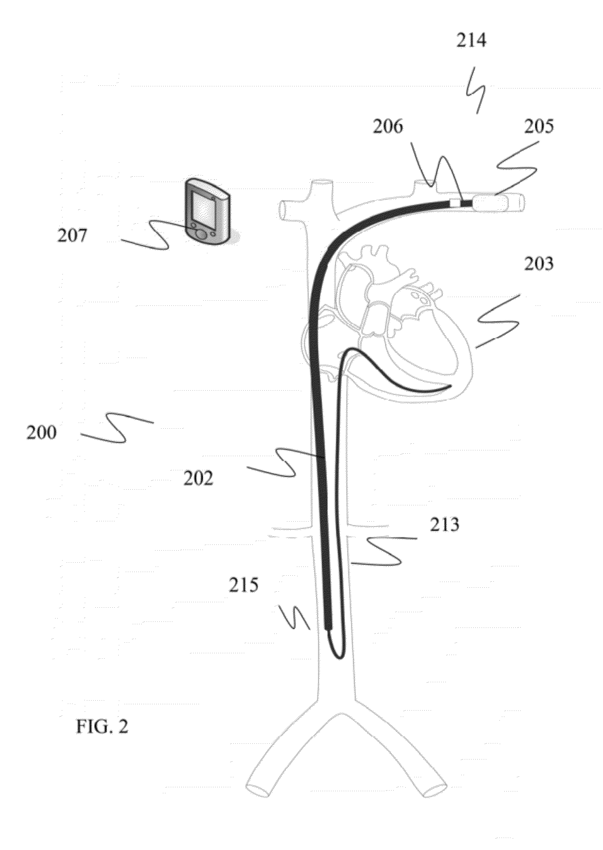Dislodgement detector for intravascular implantable medical device