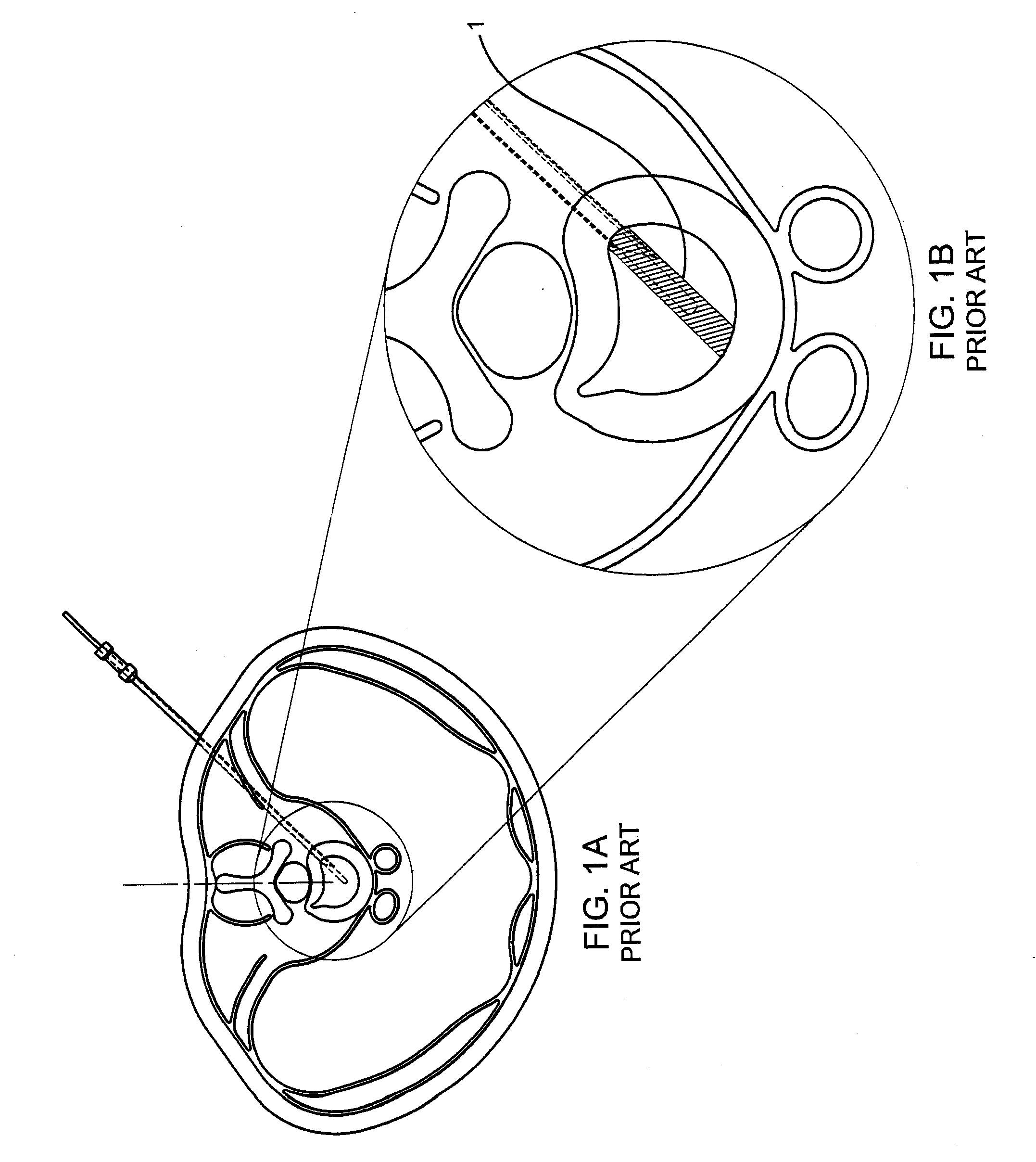 Contralateral insertion method to treat herniation with device using visualization components