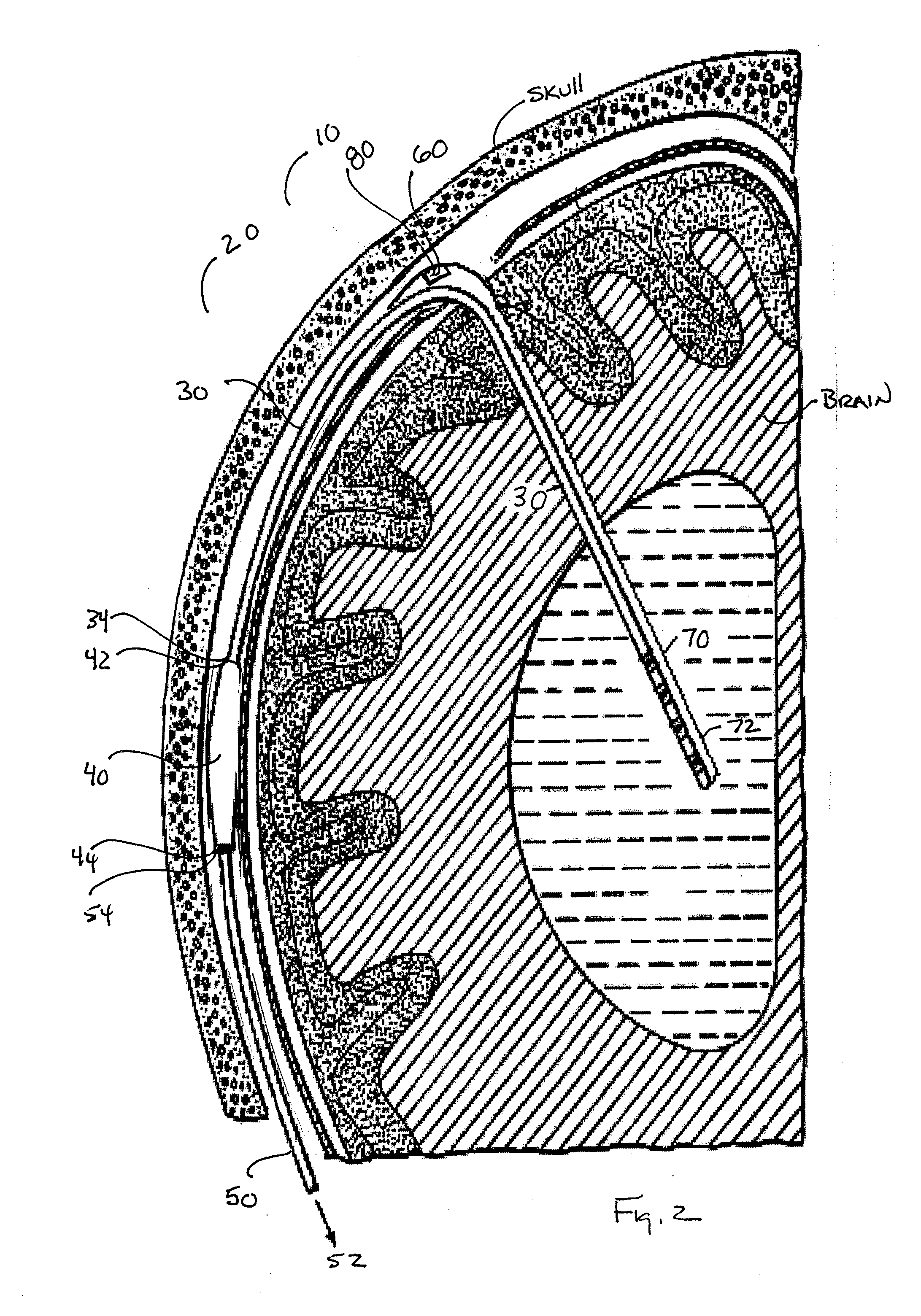 Ventricular shunt system and method