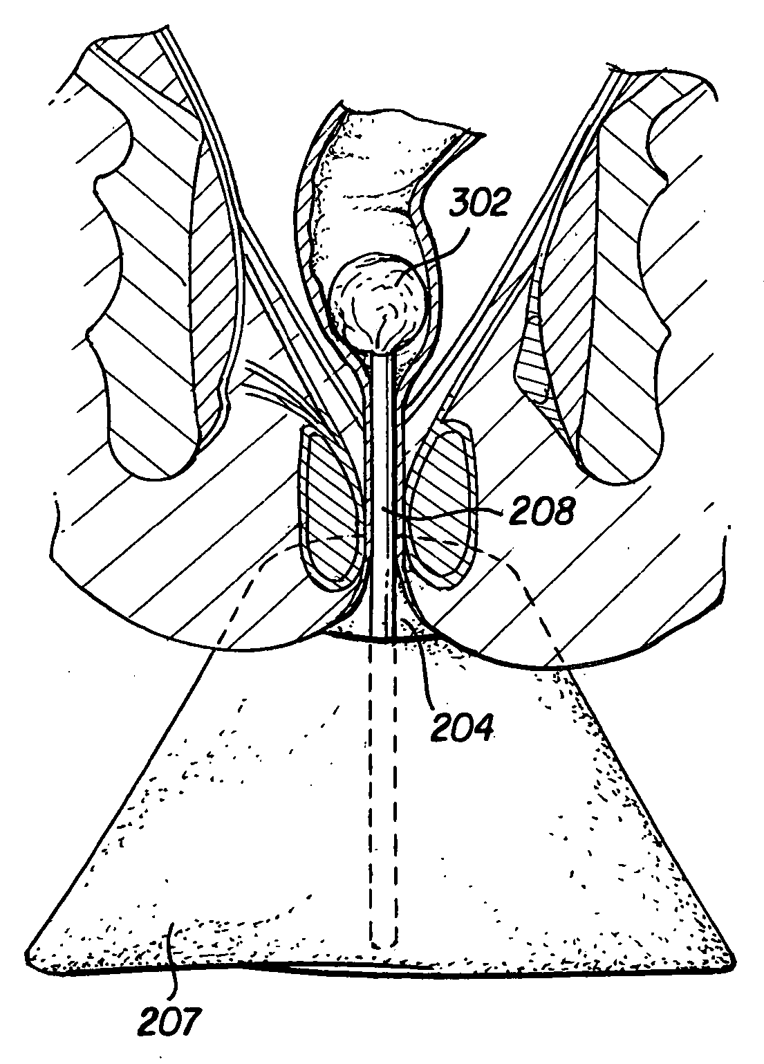 Inhibition action incontinence device and method