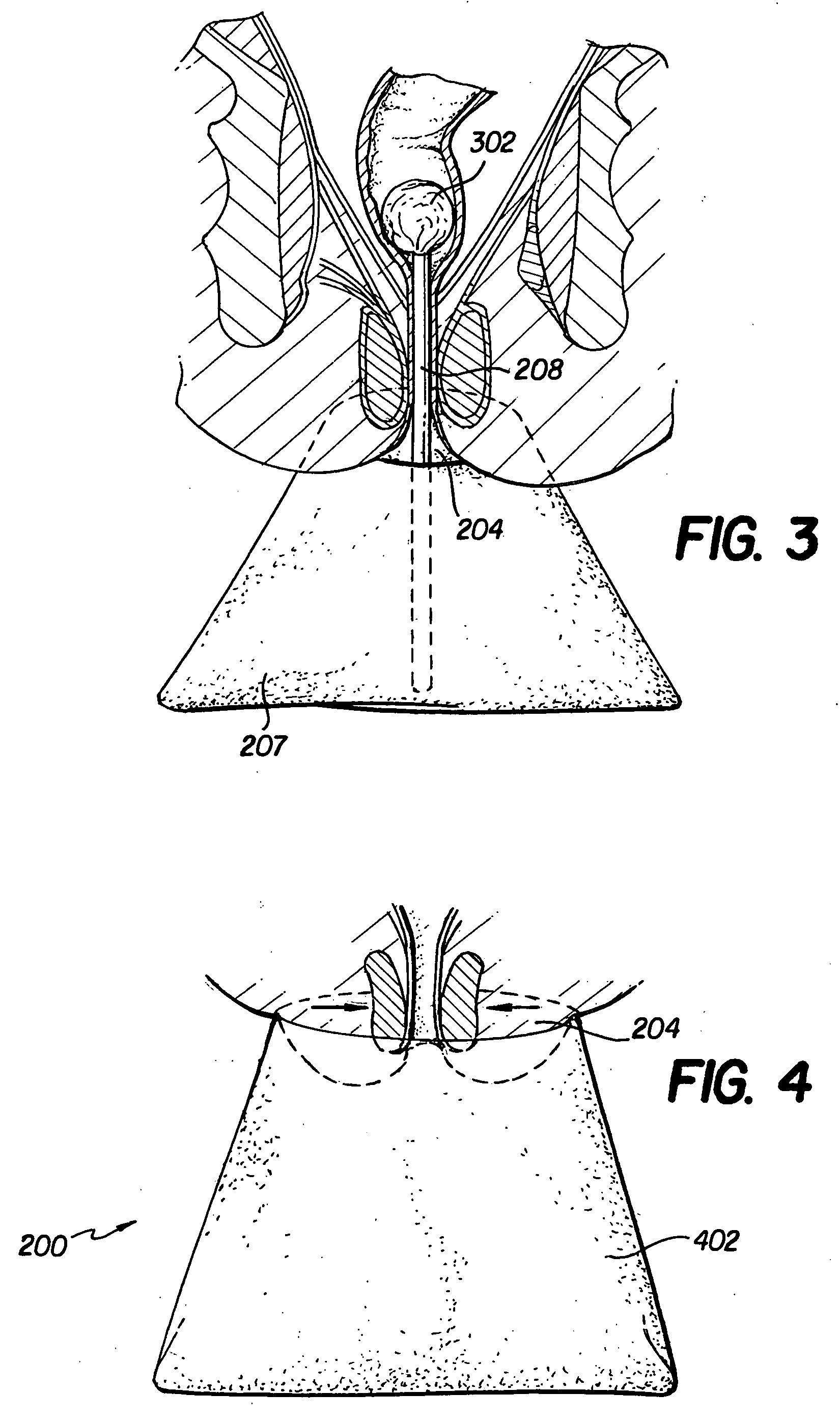 Inhibition action incontinence device and method