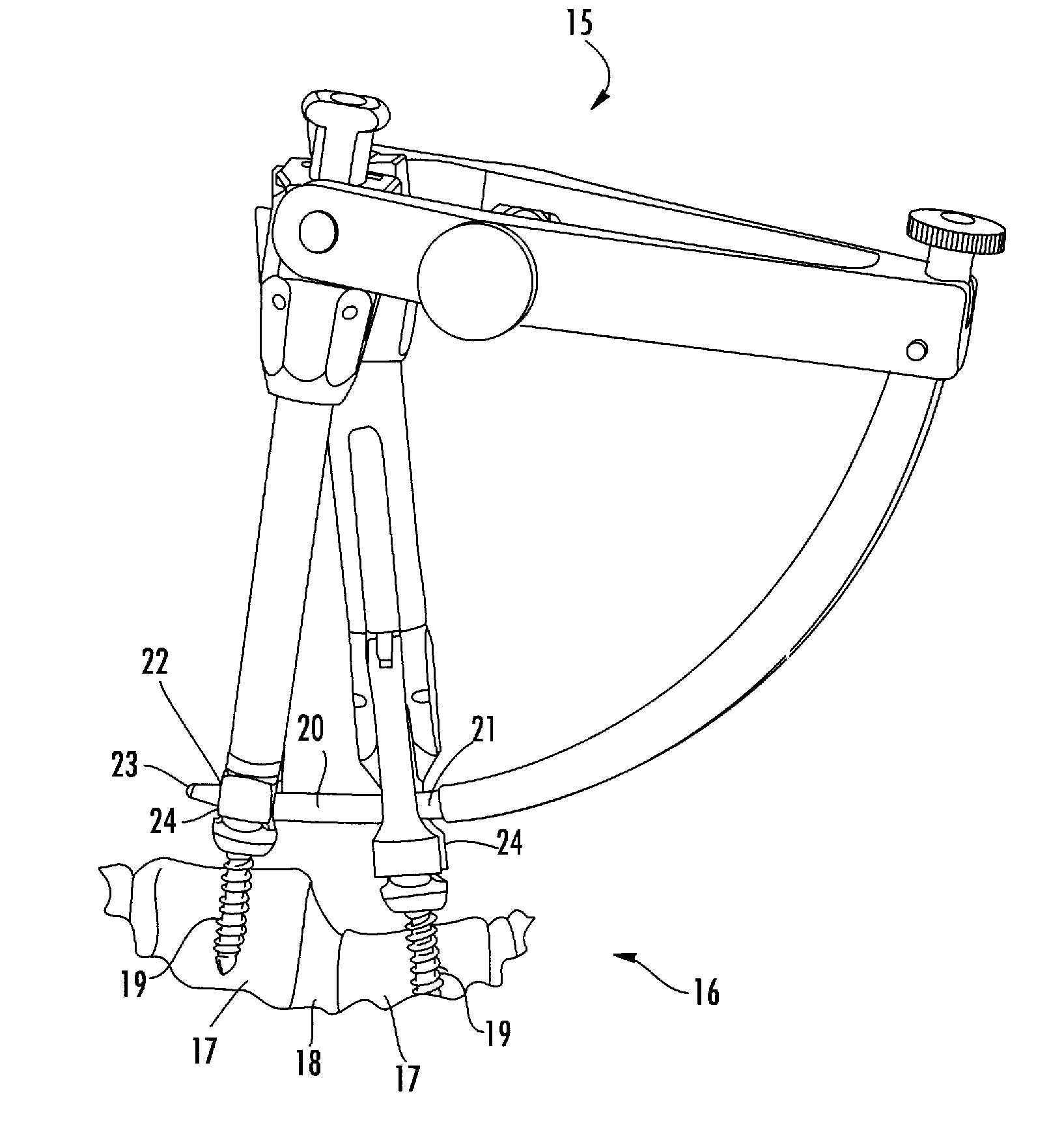 Connecting rod for bone anchors having a bioresorbable tip