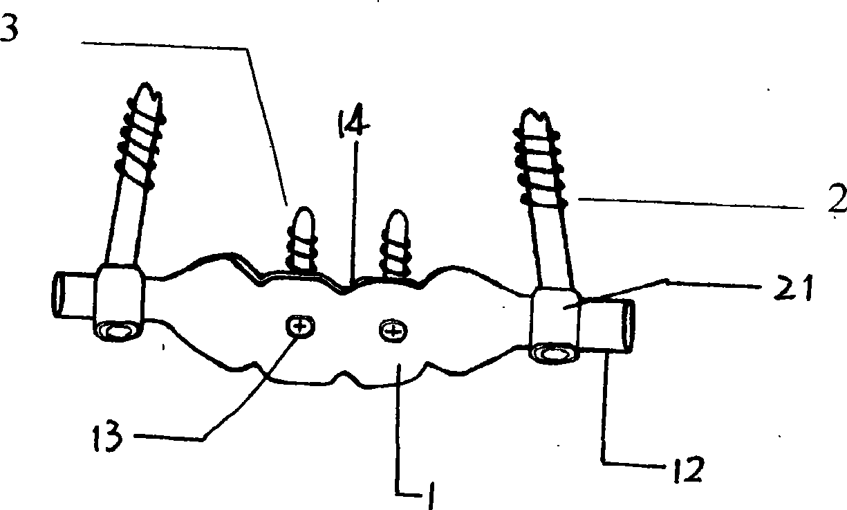 Atlas posterior plate-stick type fixator