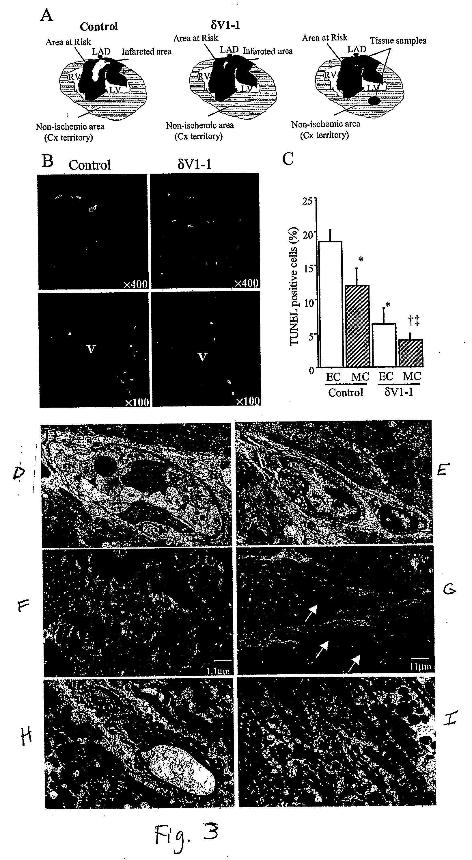 Methods and Compositions for Reducing Ischemia-Derived Microvascular Damage