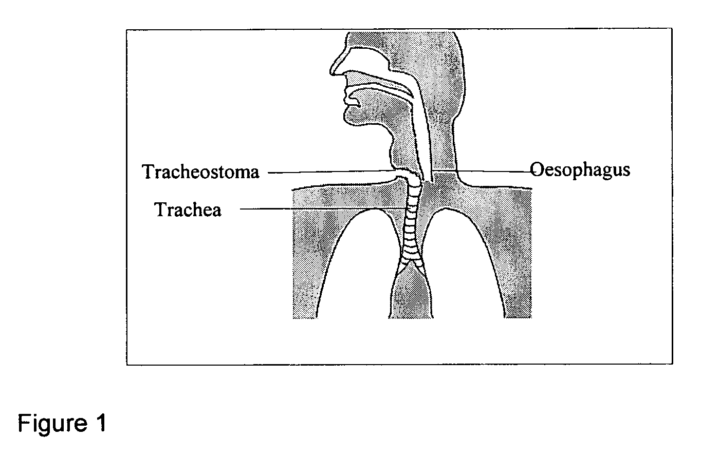 Artificial larynx
