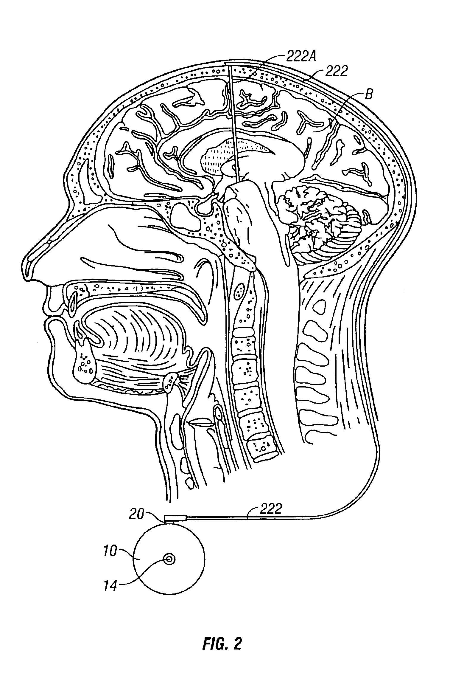 System and method of treating stuttering by neuromodulation