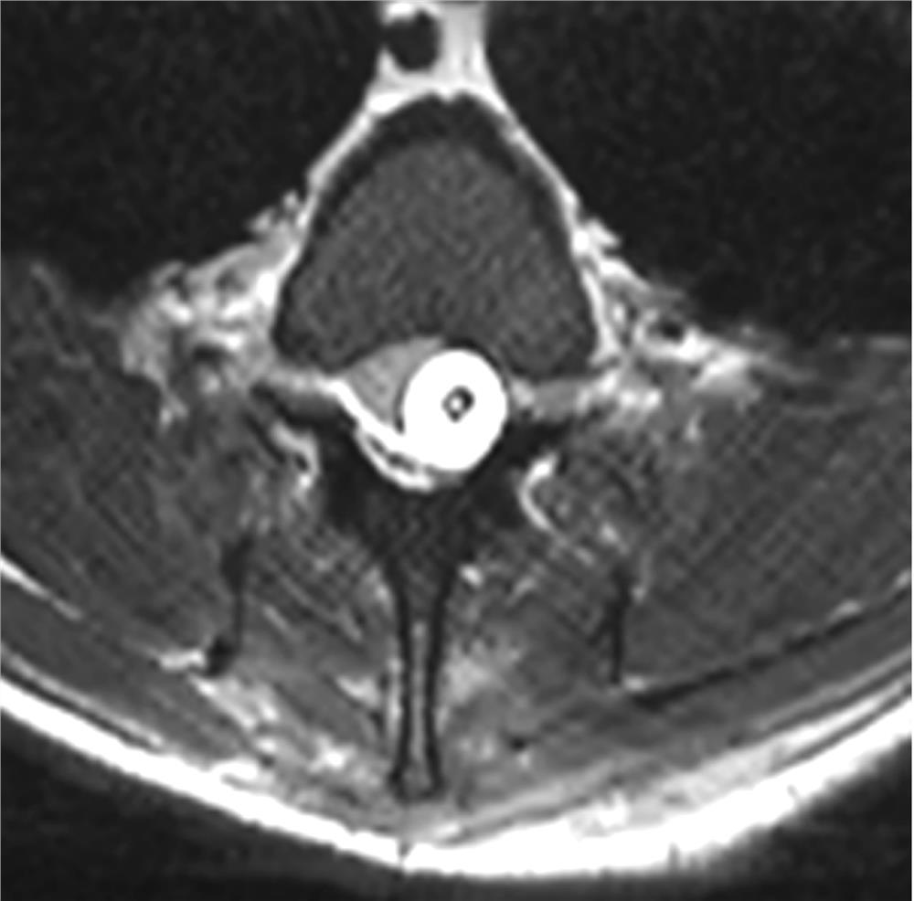 Adjustable macaque spinal cord injury method