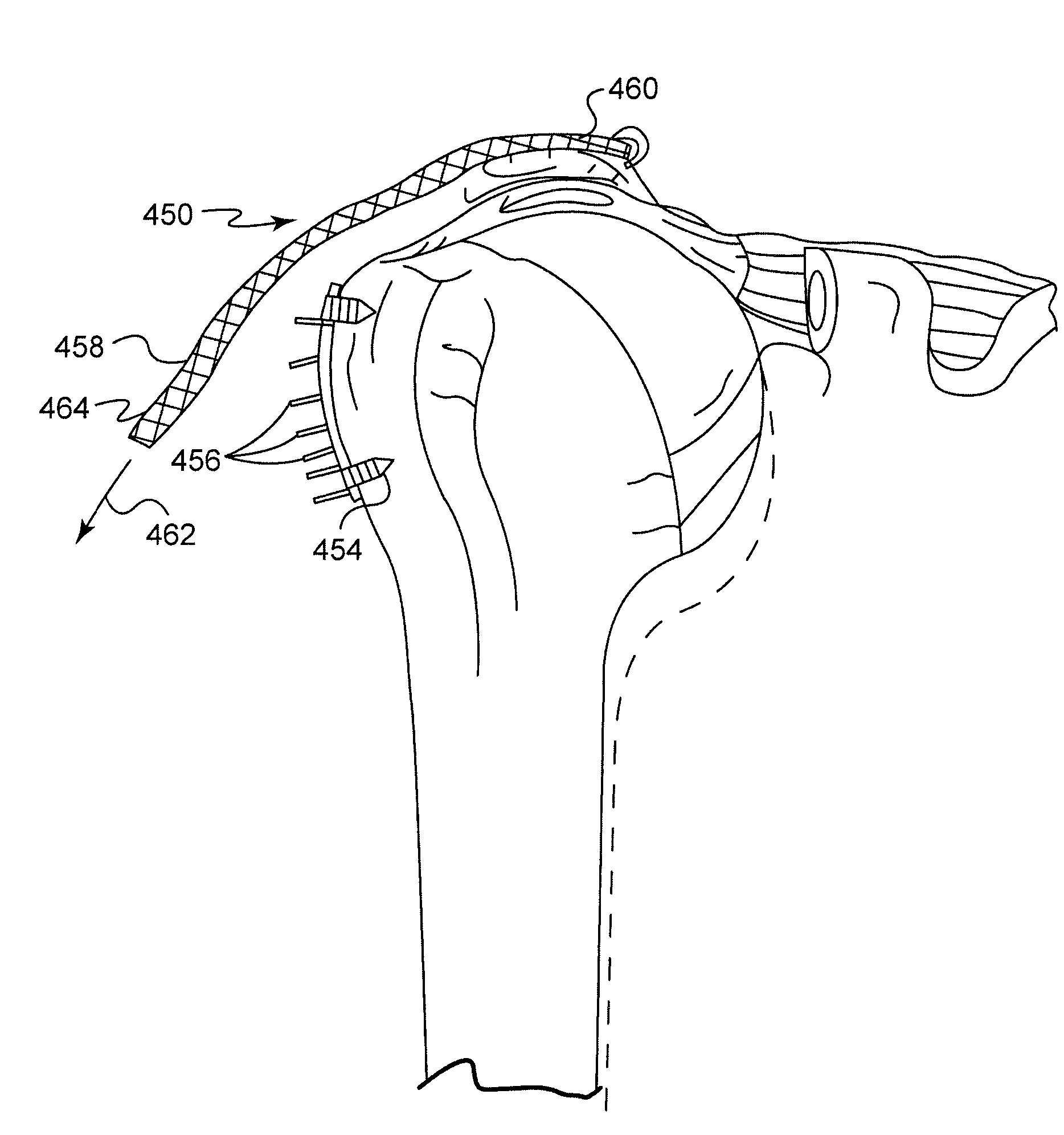 System and method for repairing tendons and ligaments