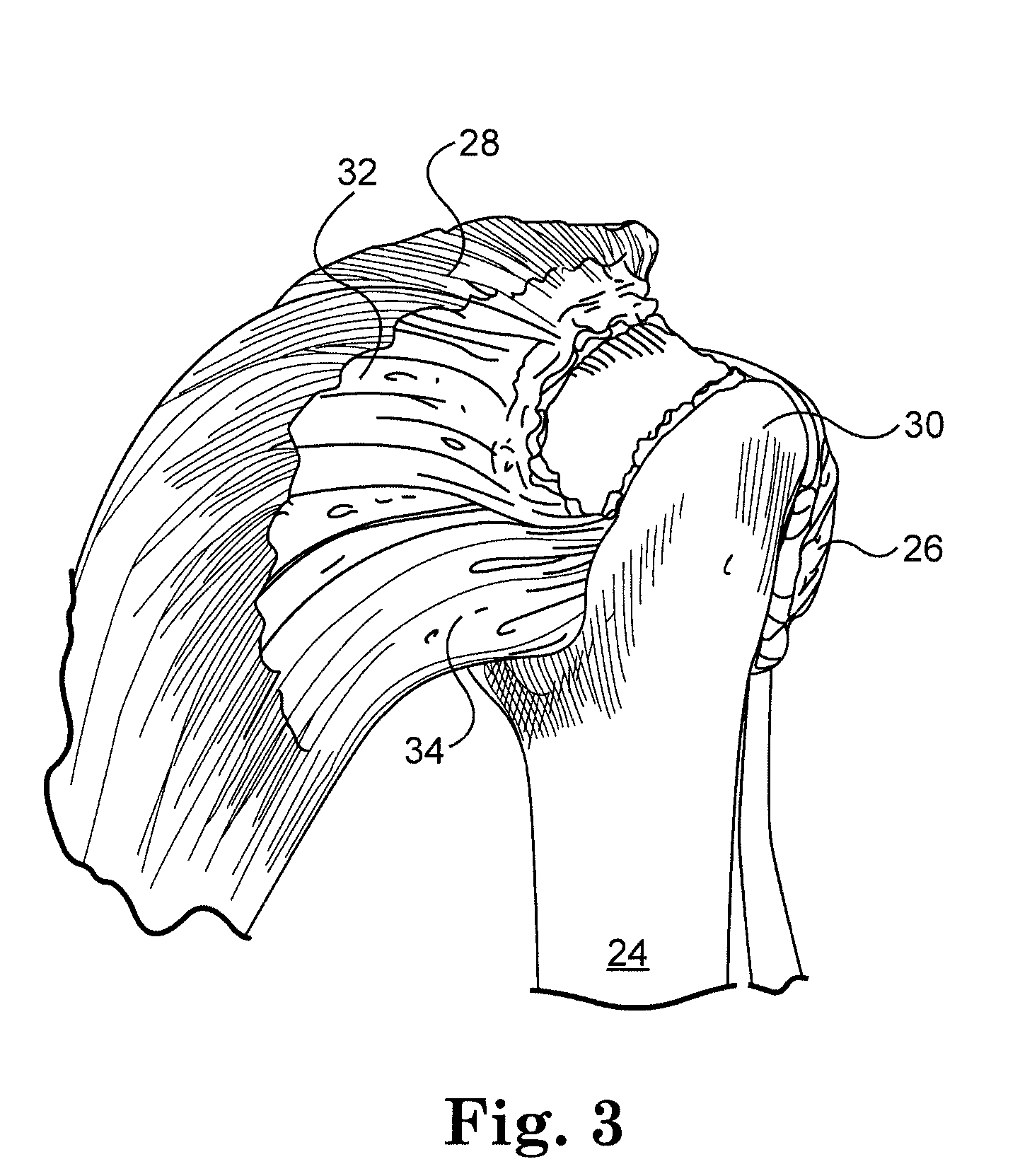 System and method for repairing tendons and ligaments