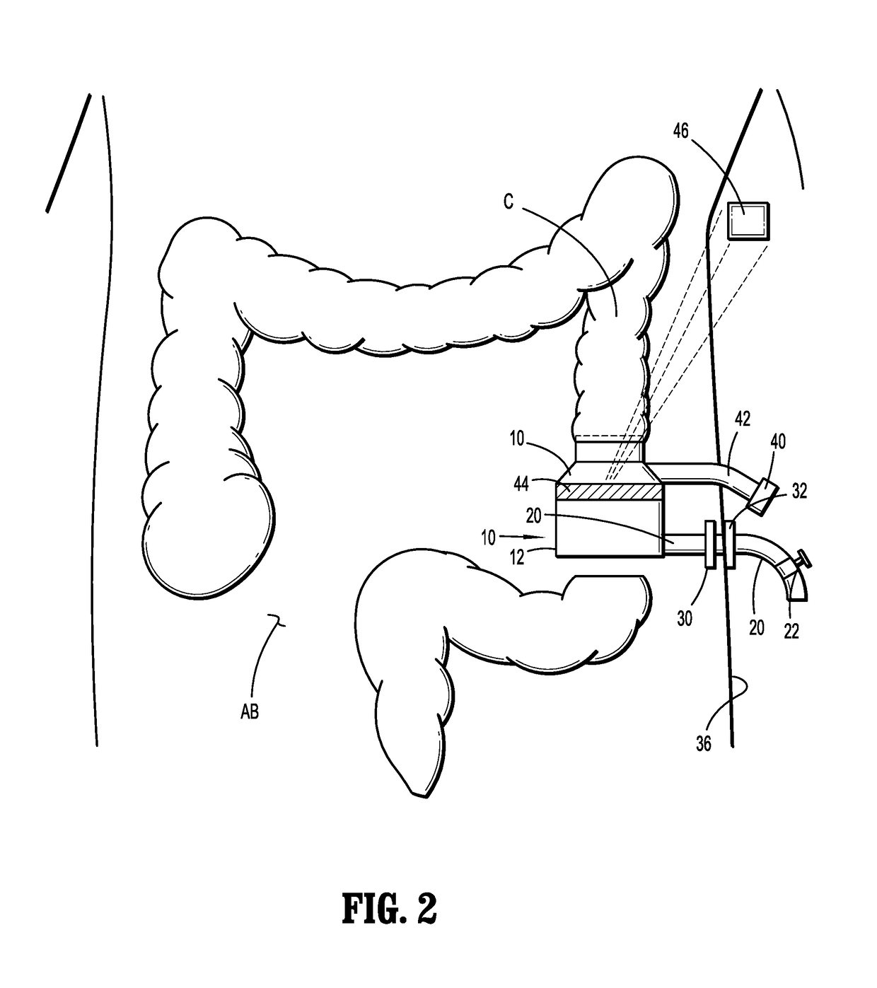 Internal colostomy catheter