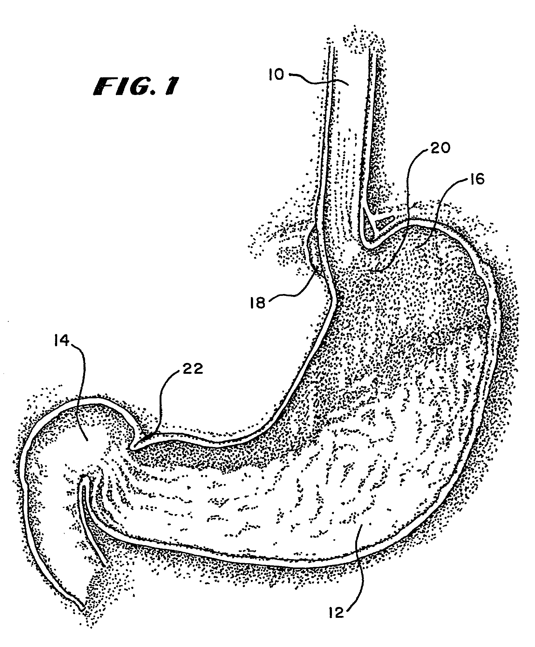 Graphical user interface for association with an electrode structure deployed in contact with a tissue region