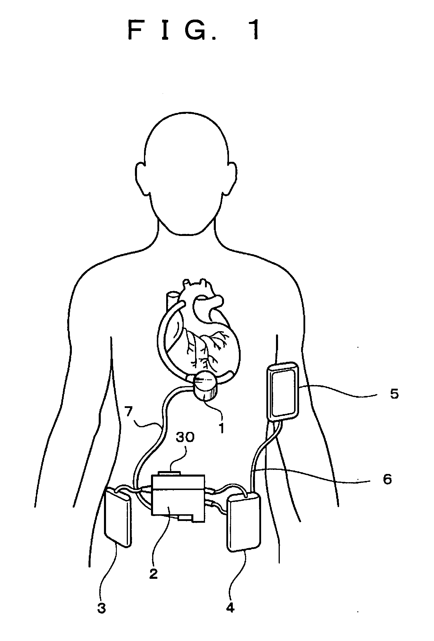 Blood pump system for artificial heart and apparatus supervisory system