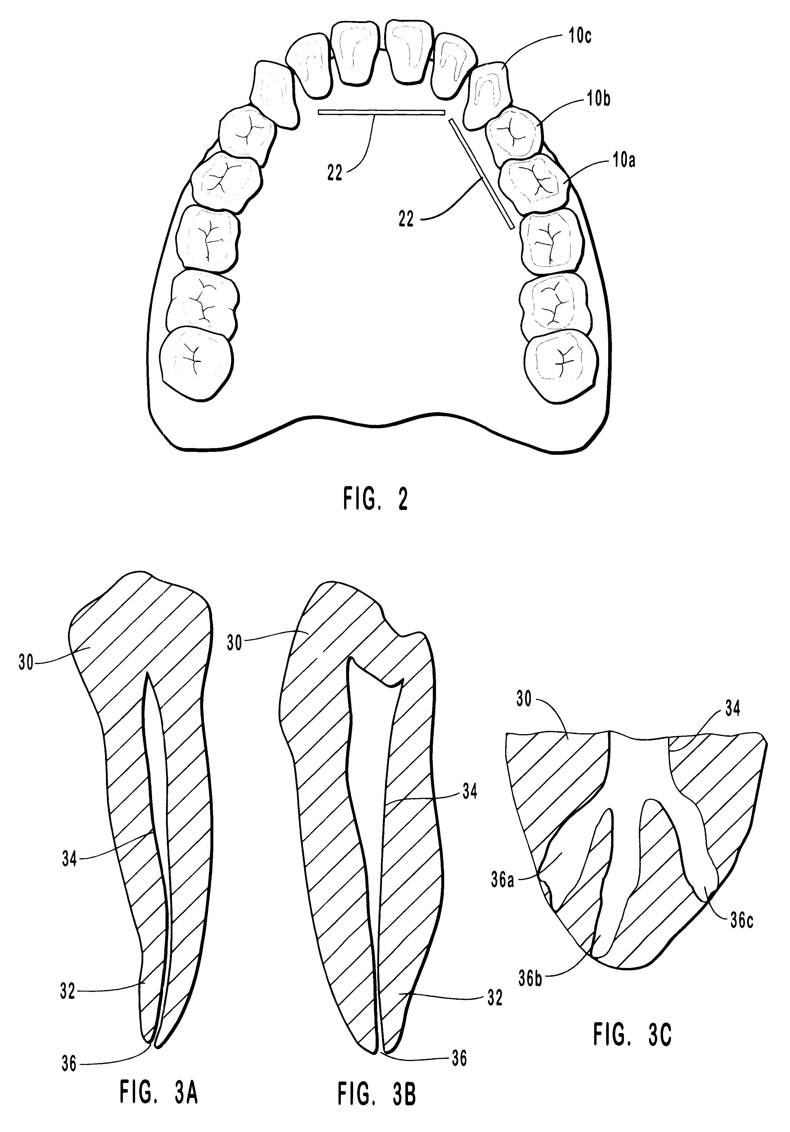 Endodontic systems and methods for the anatomical, sectional and progressive corono-apical preparation of root canals with instruments utilizing stops