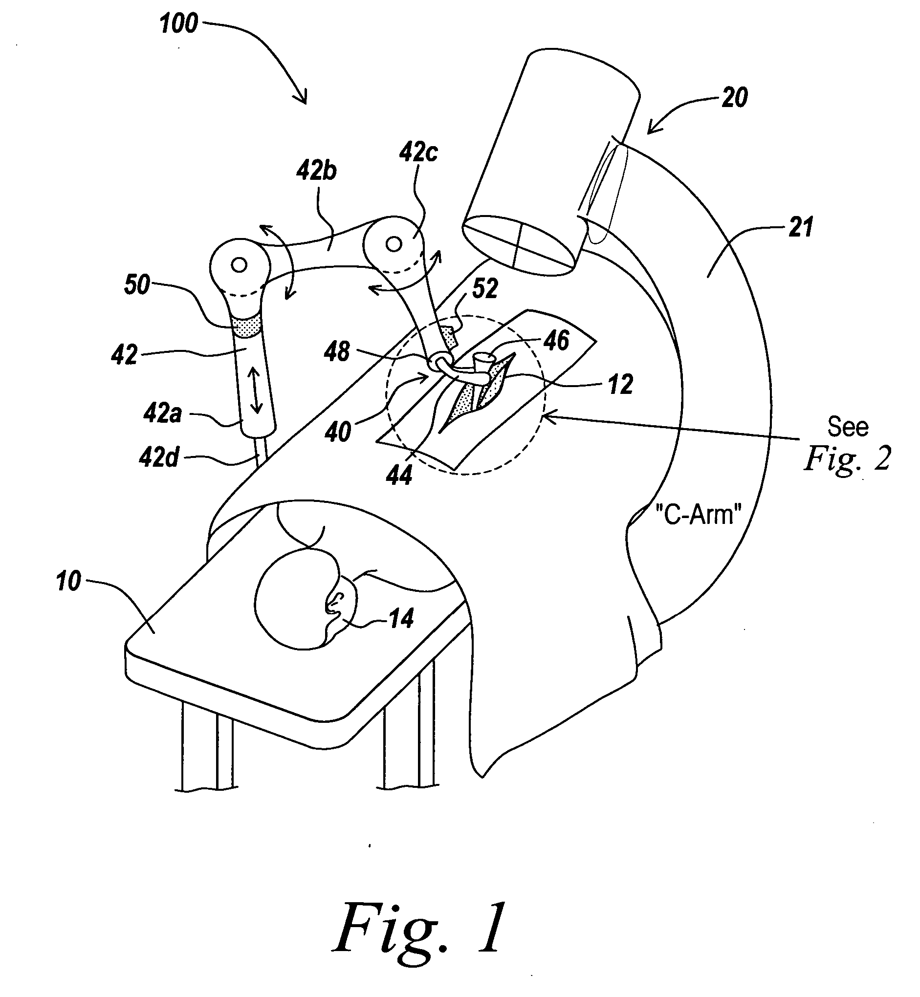 Rigidly guided implant placement with control assist