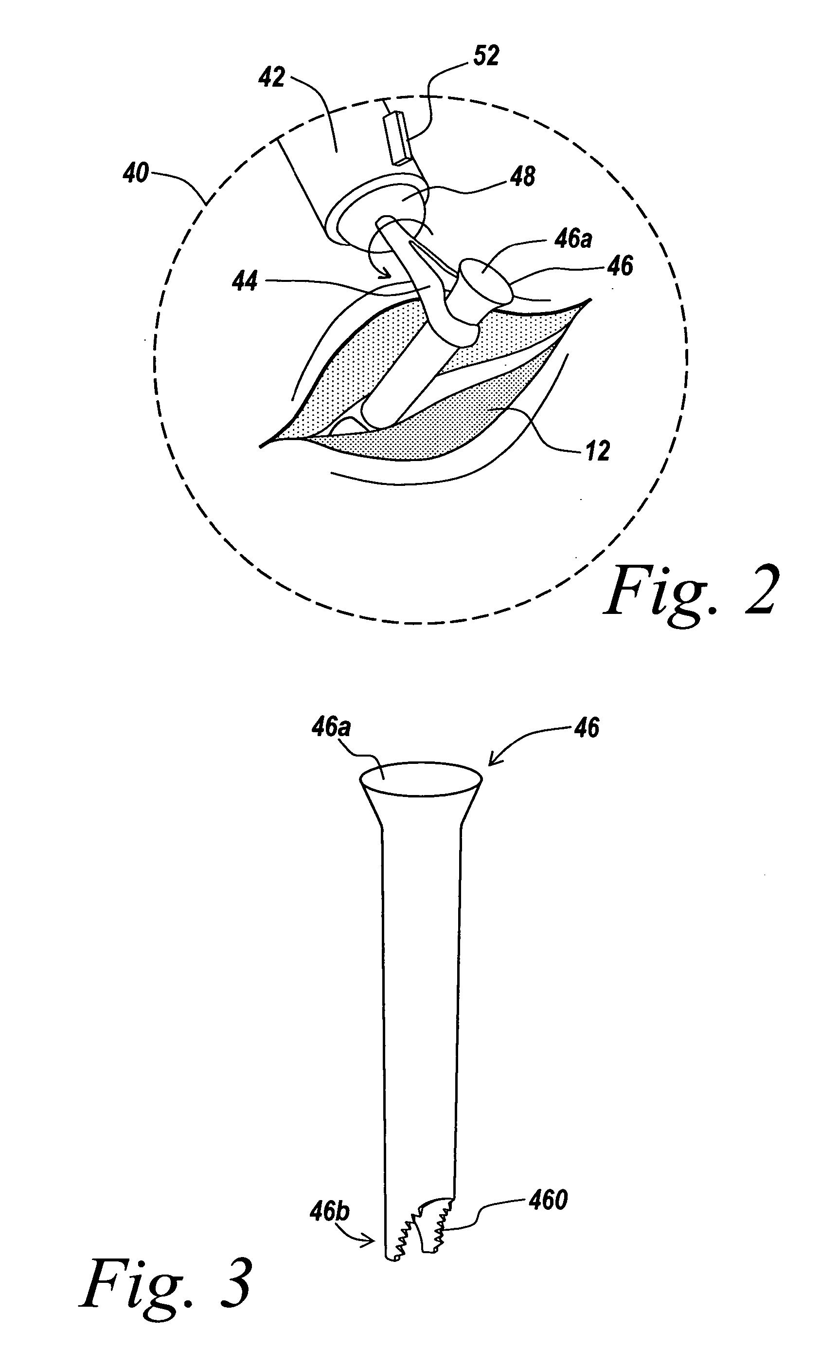 Rigidly guided implant placement with control assist