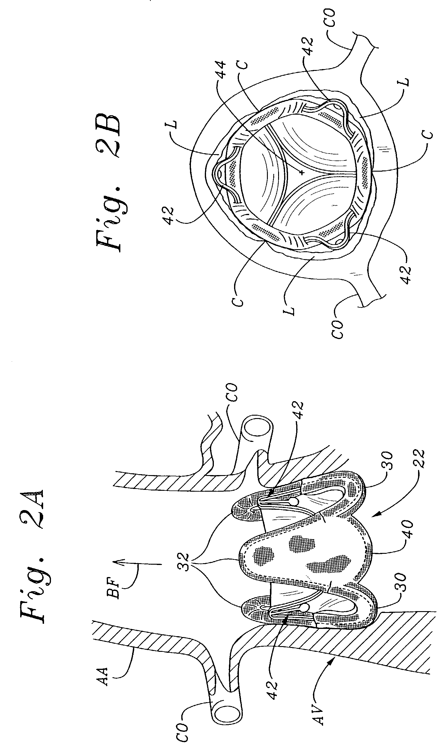 Minimally-invasive heart valve with cusp positioners