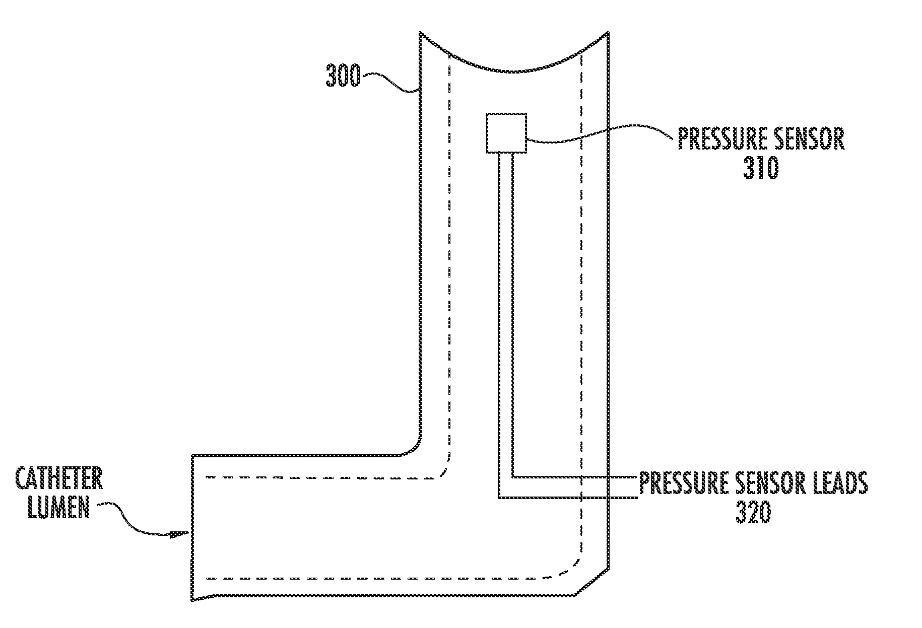 Techniques for evaluating stress urinary incontinence (SUI) using involuntary reflex cough test