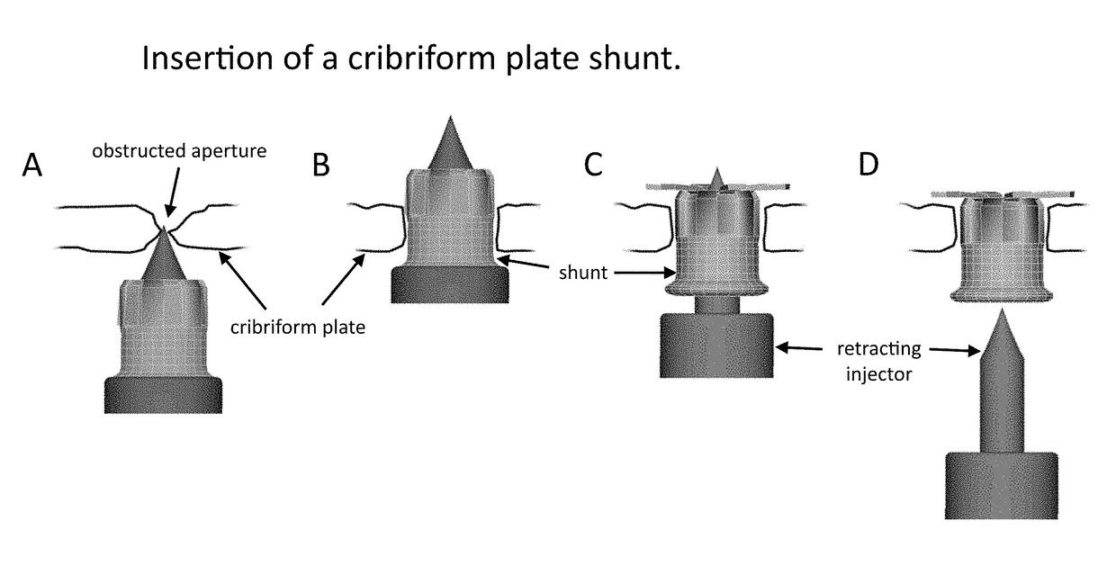 Method and use of draining fluid above the cribriform plate