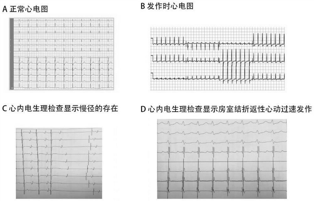 A screening kit for paroxysmal supraventricular tachycardia
