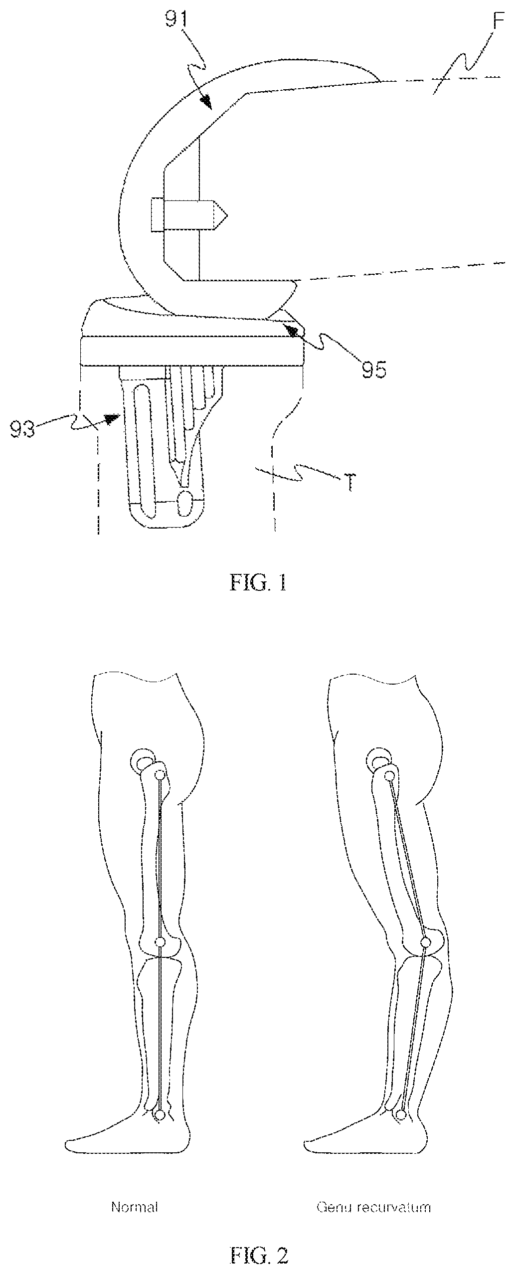 Knee joint implant preventing hyperextension