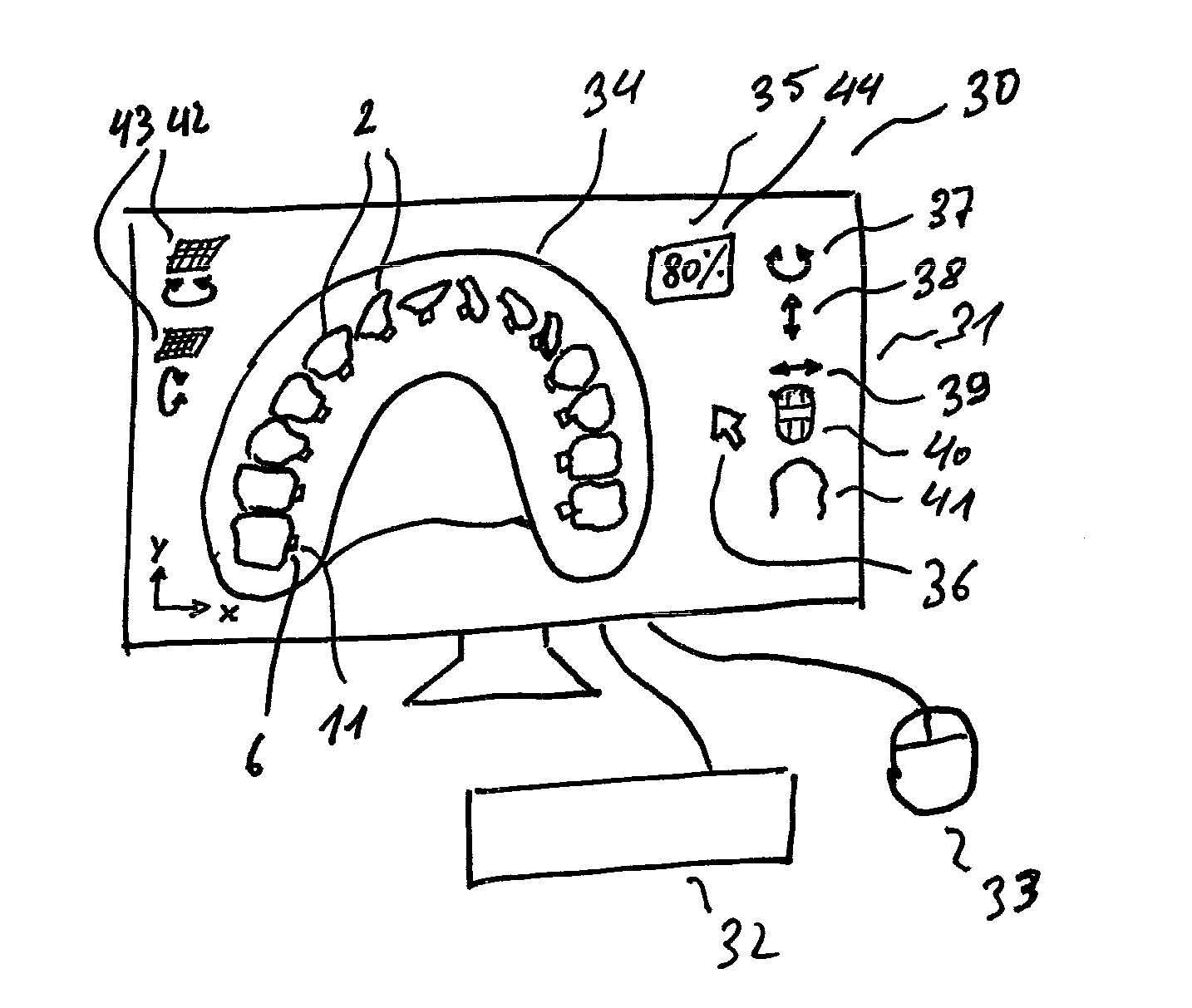 Bracket system and method for planning and producing a bracket system for the correction of tooth malpositions